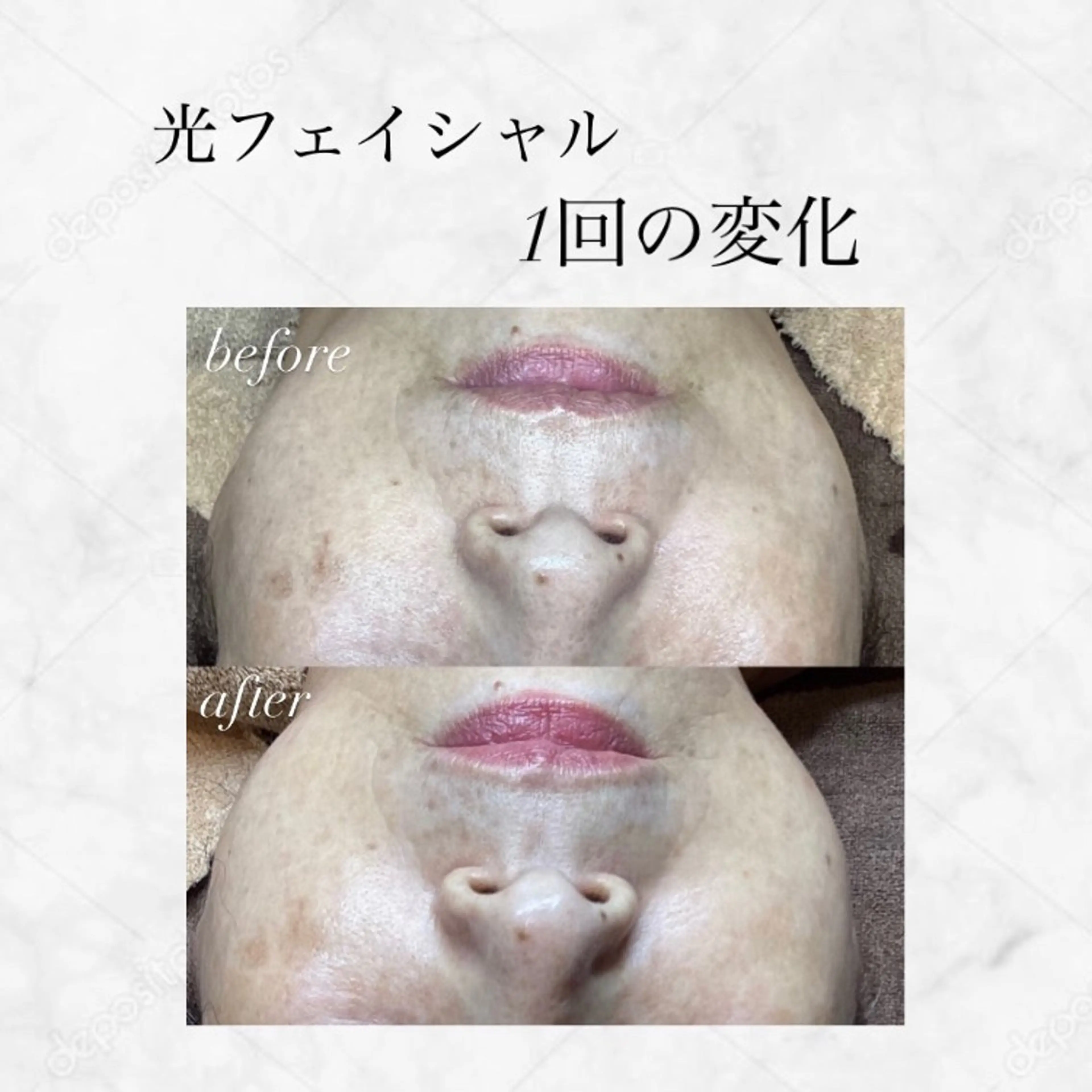 Rifuro 勝田台エステ所属・Rifuro勝田台 ララピール・毛穴洗浄のエステ・リラクイメージ