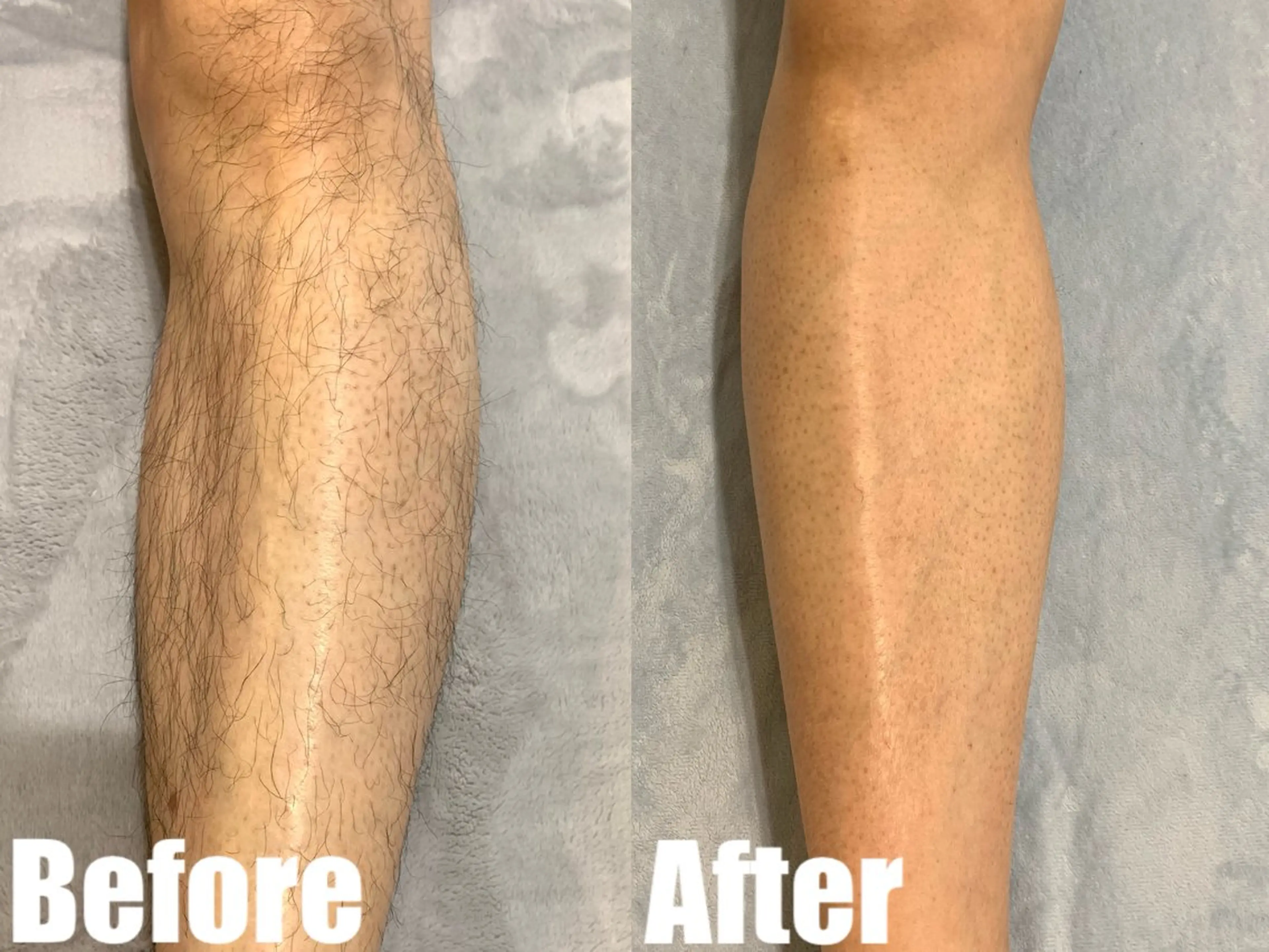 メンズ 都度払い脱毛ブレア /代々木のエステ・リラクイメージ