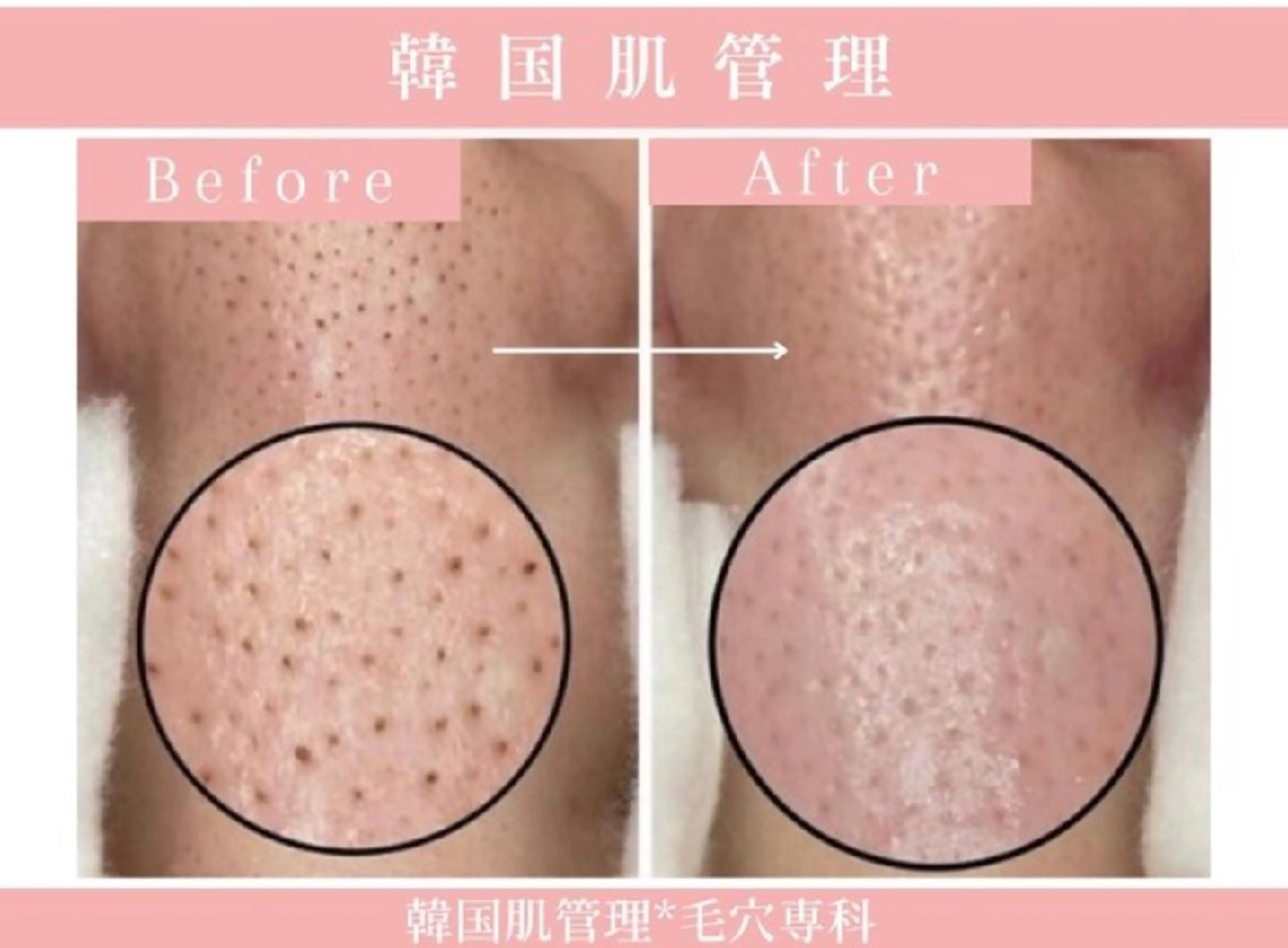 【⚖️フェイシャルエステ スタンダードコース✨】光フェイシャル+韓国式毛穴ケア+ヒト幹細胞美容液の写真