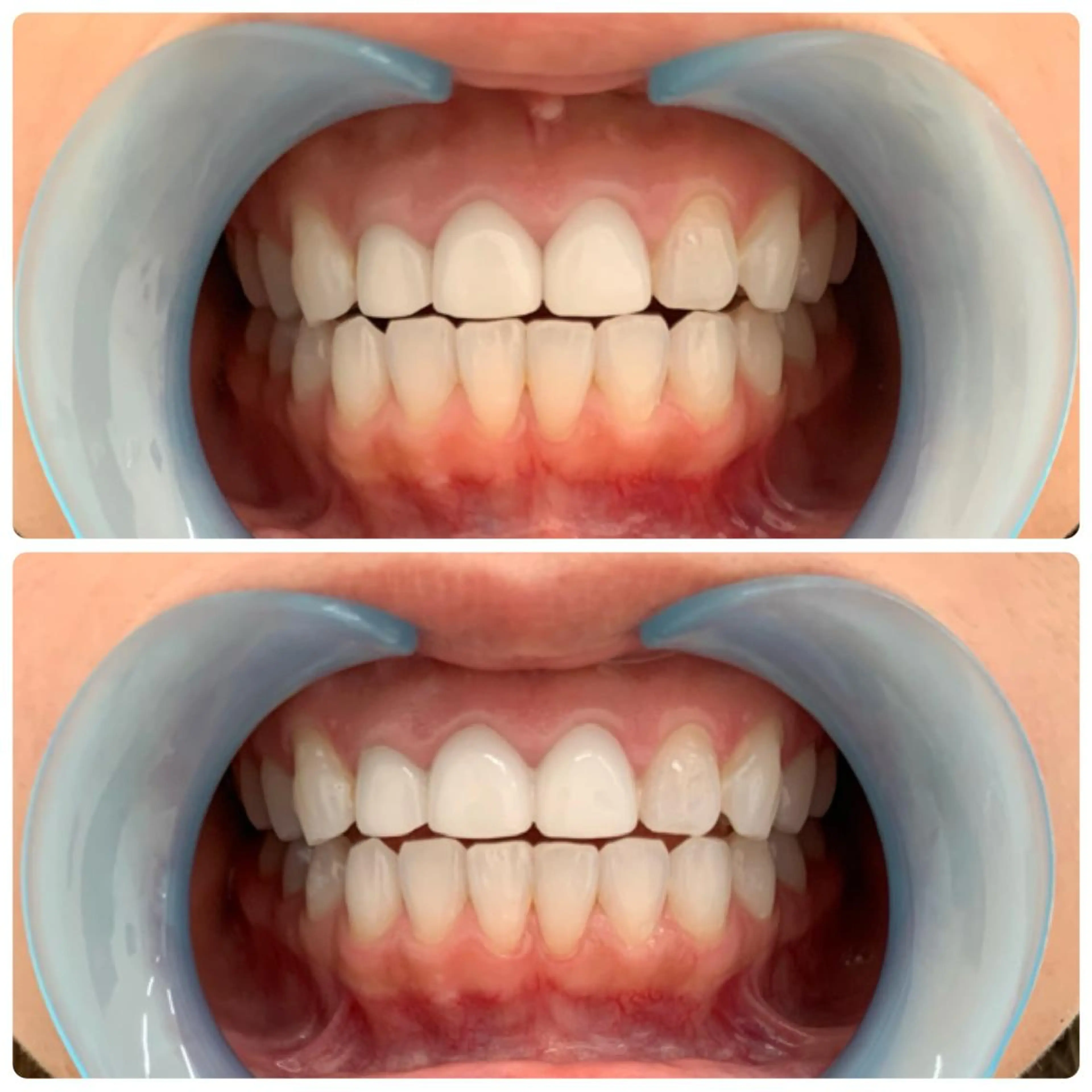 白さ実感✨回数券セルフホワイトニング🦷の写真