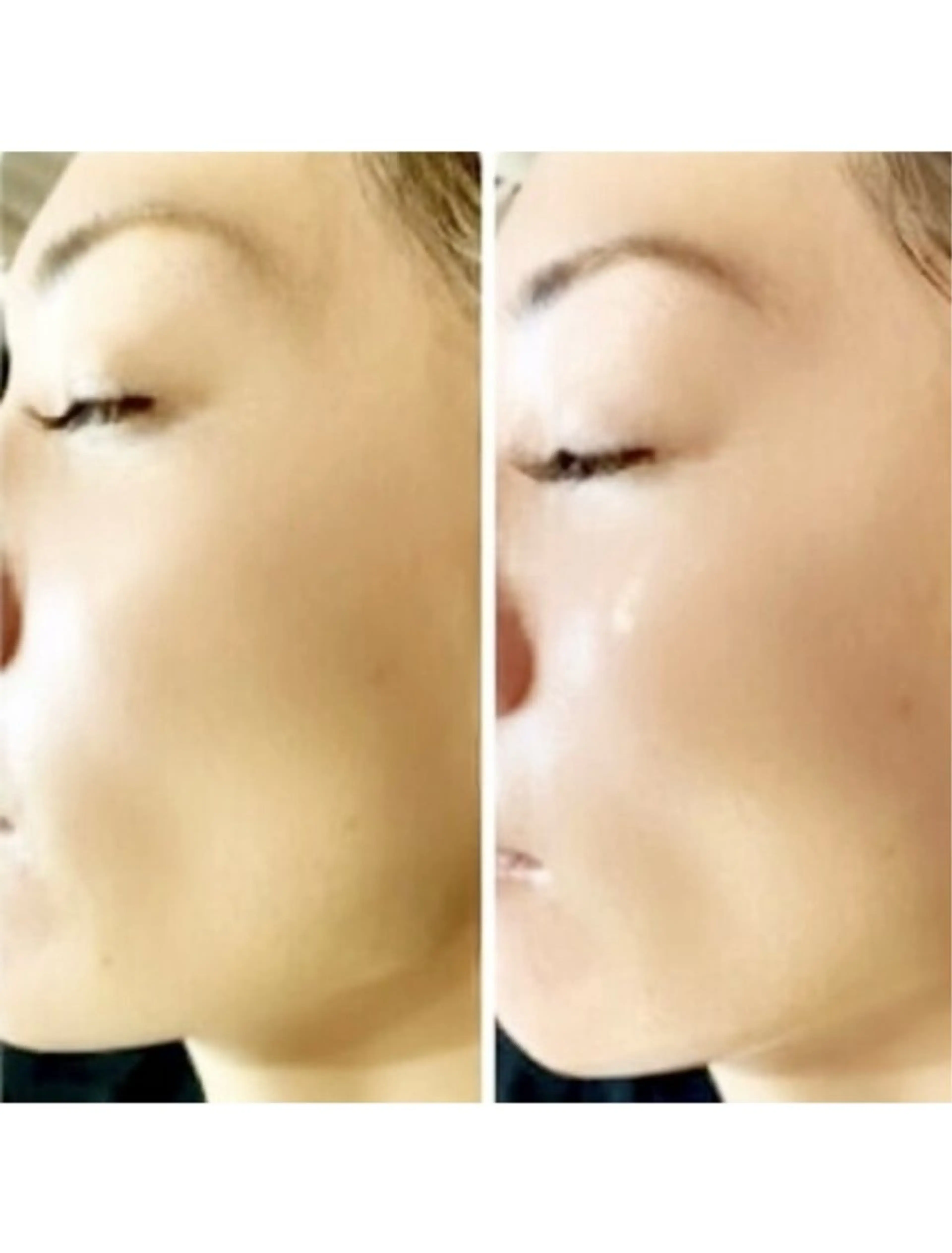 フェイスWax脱毛☆ 額・頬・鼻・鼻下・口周り・眉周りをWaxでムダ毛や古い角質、皮脂汚れを除去☆一度でツヤツヤ肌に✨の写真