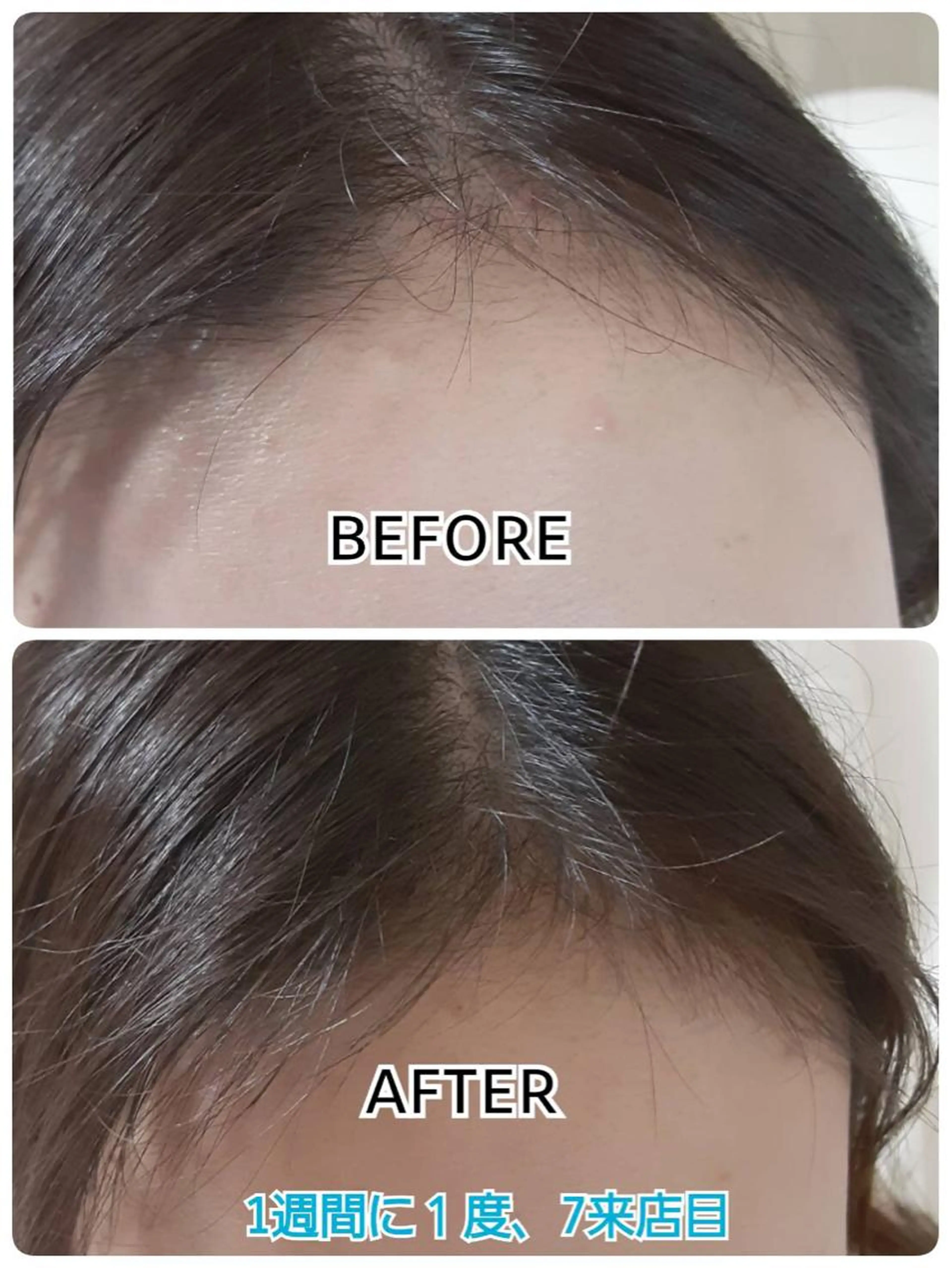 【期間限定企画】LEDスカルプモニター価格✨20照射(10来店)！頭皮お写真撮影🆗週1回来店できる方限定でございますの写真