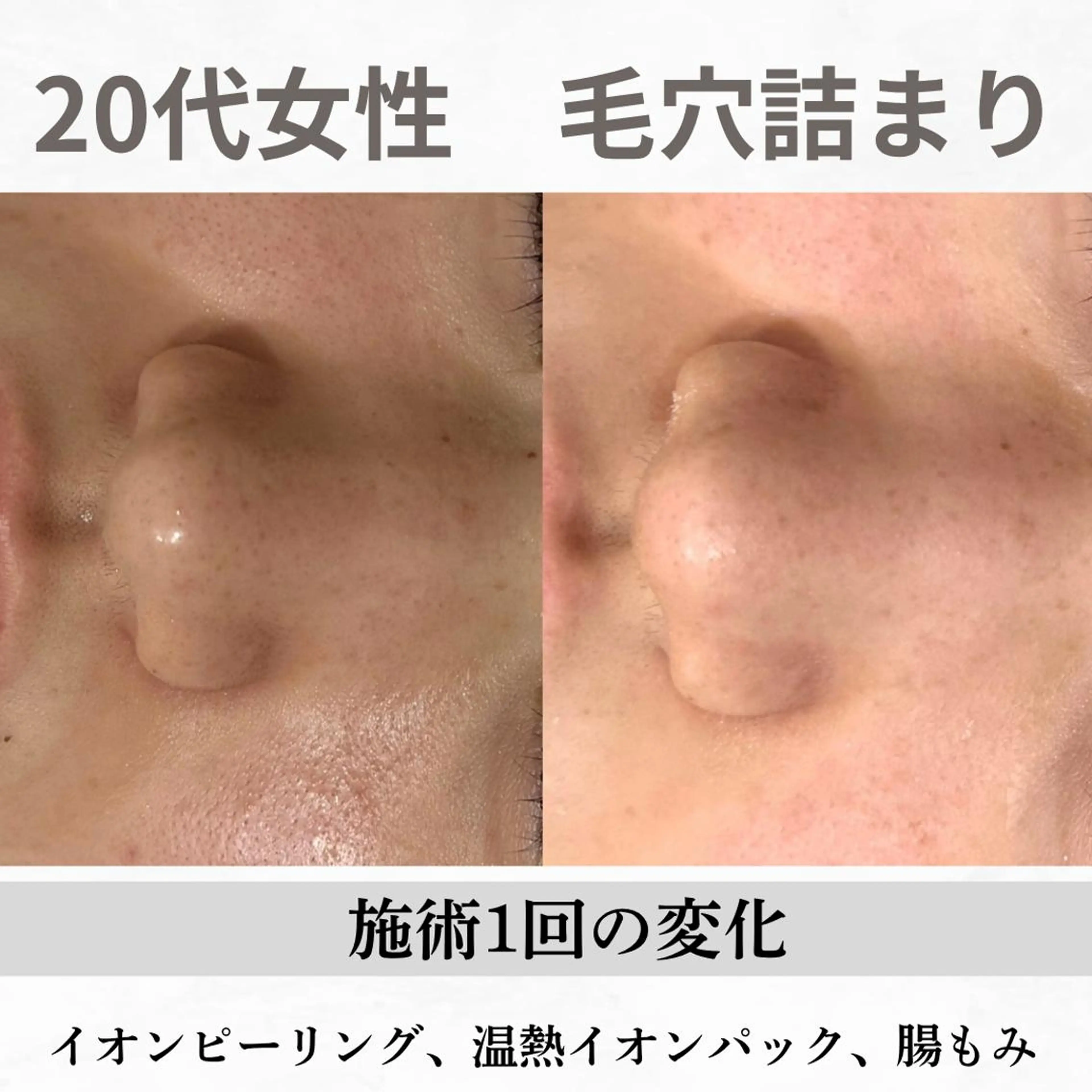 重度ニキビ専門🌷 ダウンタイムなしのエステ・リラクイメージ