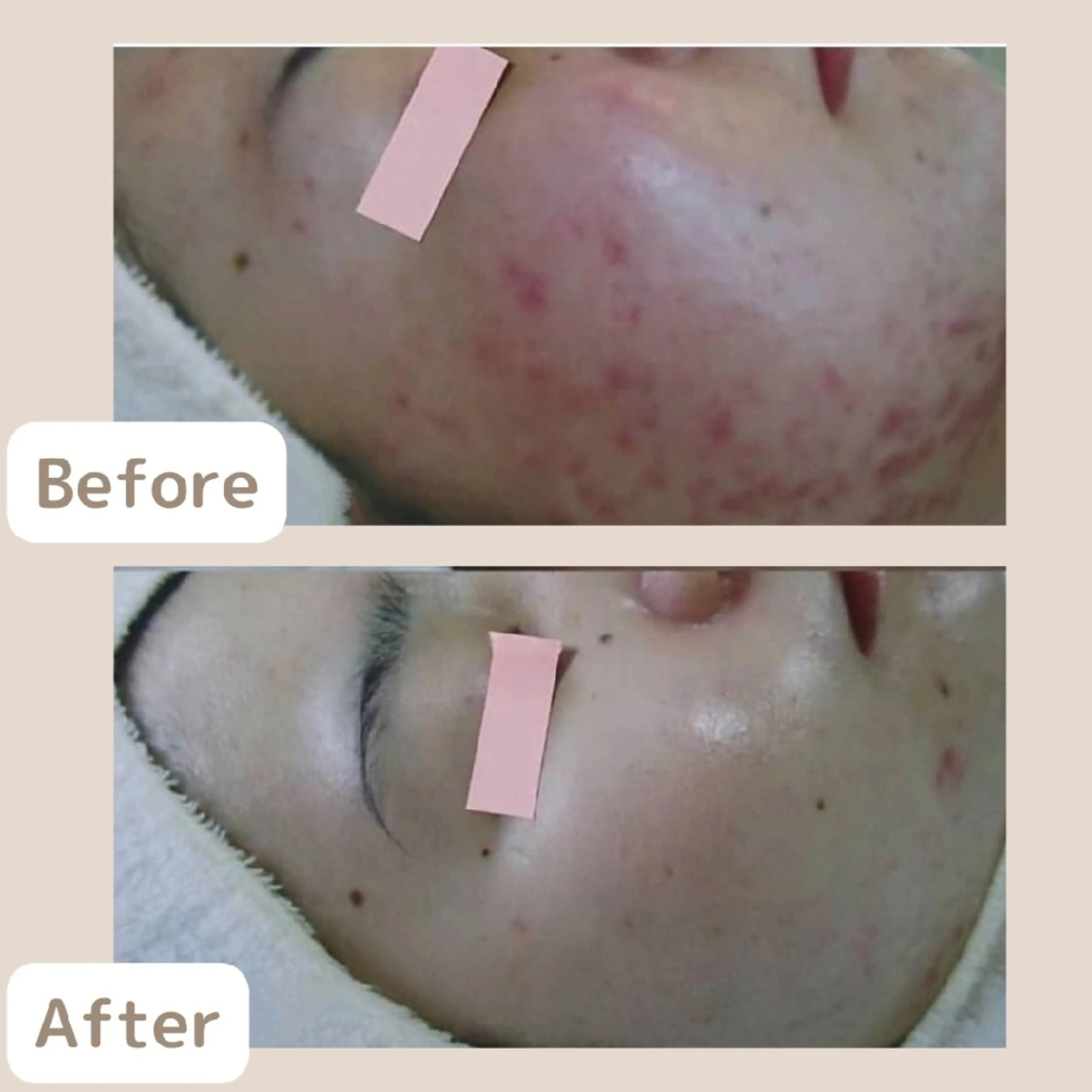 〈ニキビケアサロン〉 レゾン京橋店/ 浅川のエステ・リラクイメージ