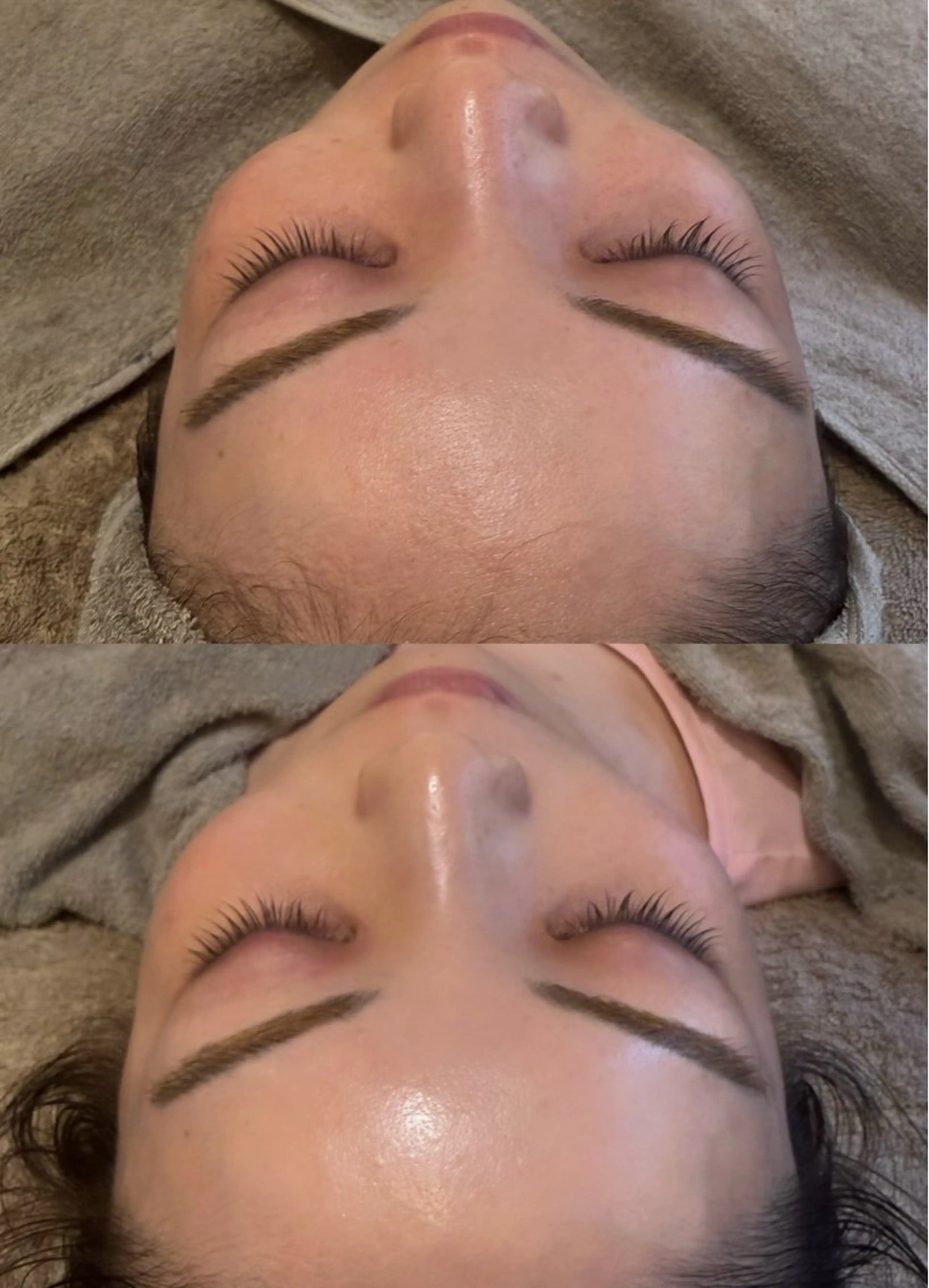 人気No.3【毛穴洗浄+電気美容鍼】エレクトロポレーション導入付き👃ごっそり汚れを取り除き美肌&小顔を✨卵肌🥚の写真