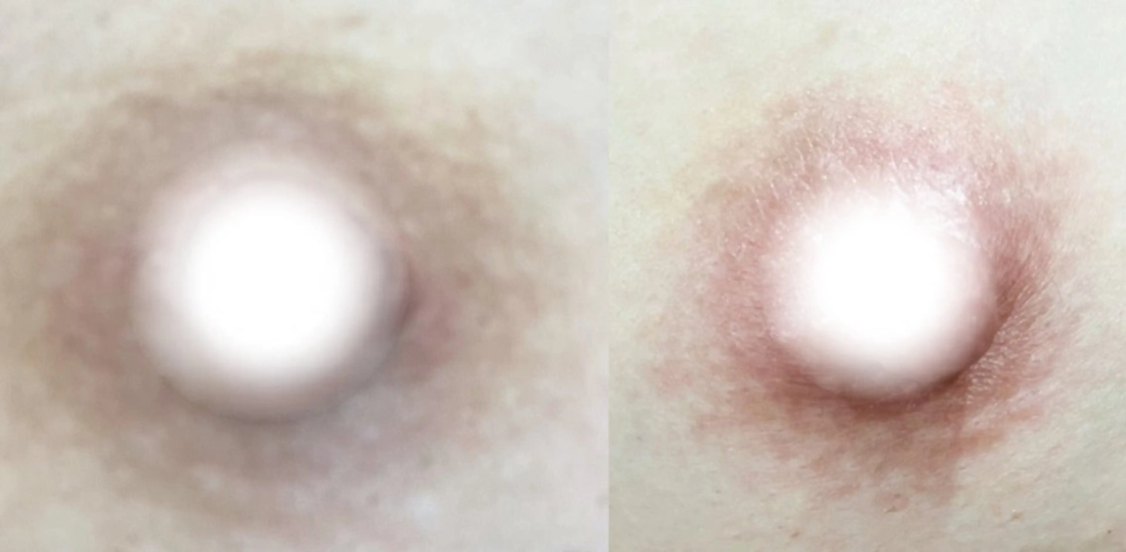 【話題のローマピンク✨】乳輪乳頭(ニップル)の黒ずみを改善!本来のピンクに🎵アフタークリーム合計3本付き✨の写真