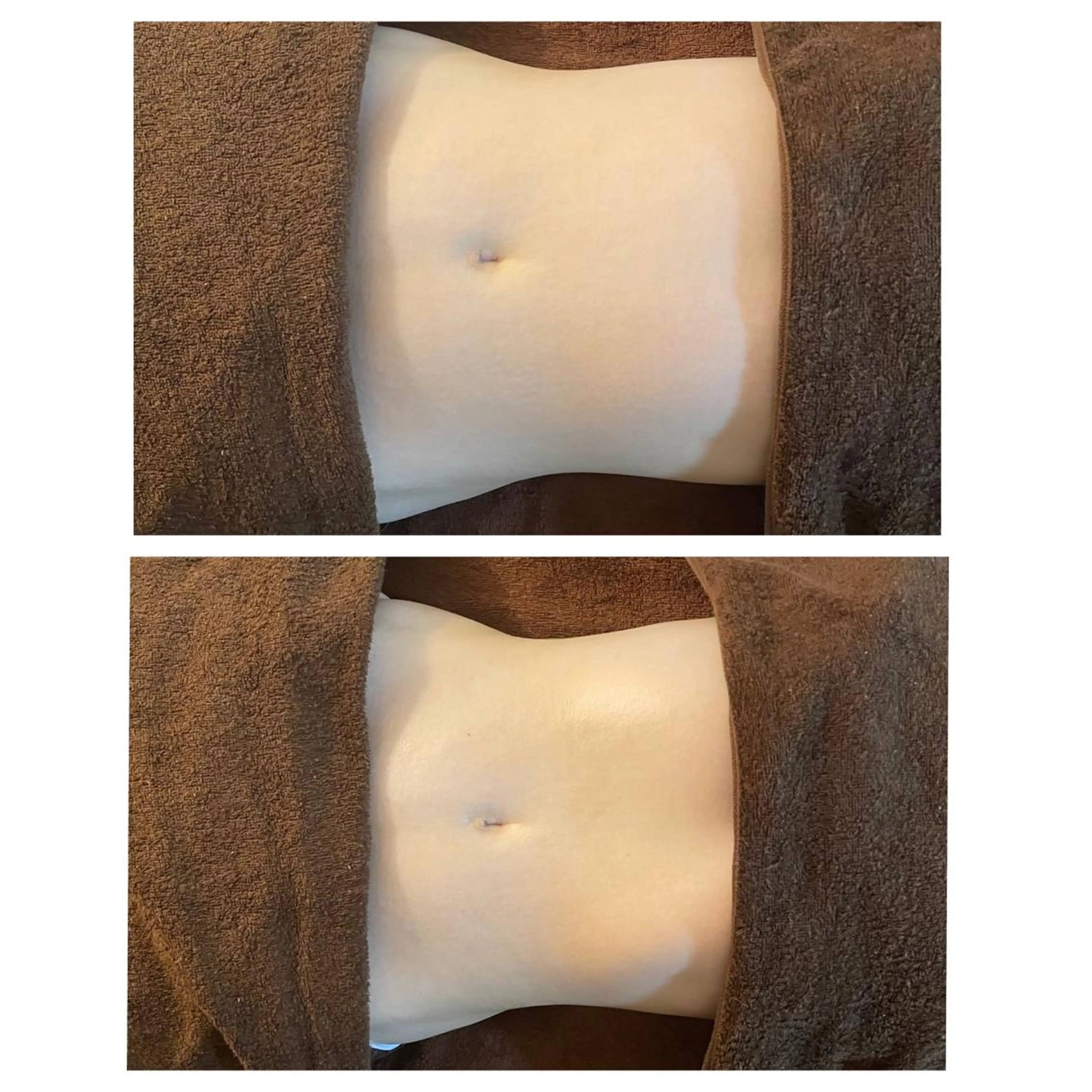 腸ドレナージュの写真