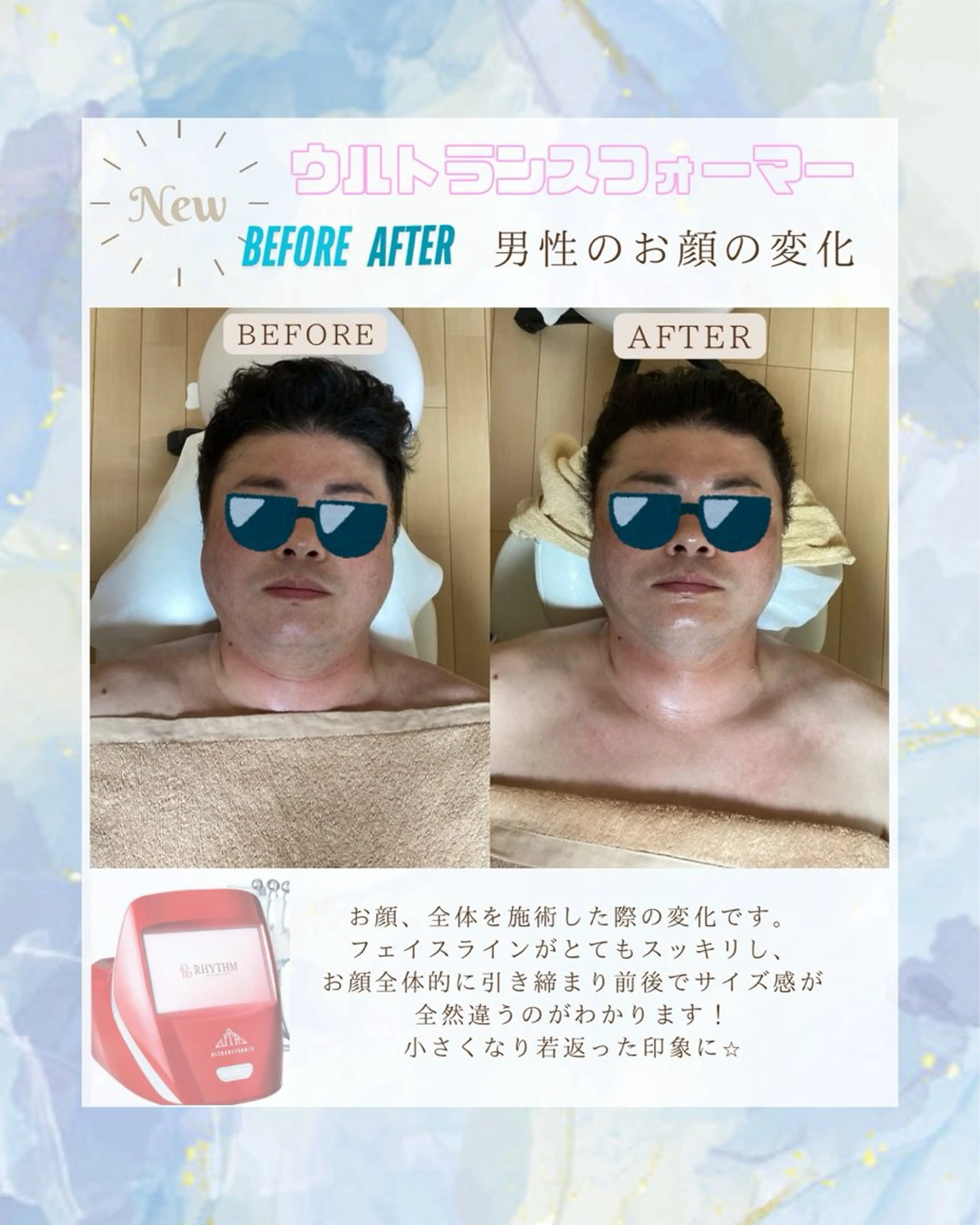 【フェイシャルケア】フェイスラインやデコルテをスッキリしたい方におすすめ🍑🩵ブライダルや特別な予定の前のケアにも💗の写真