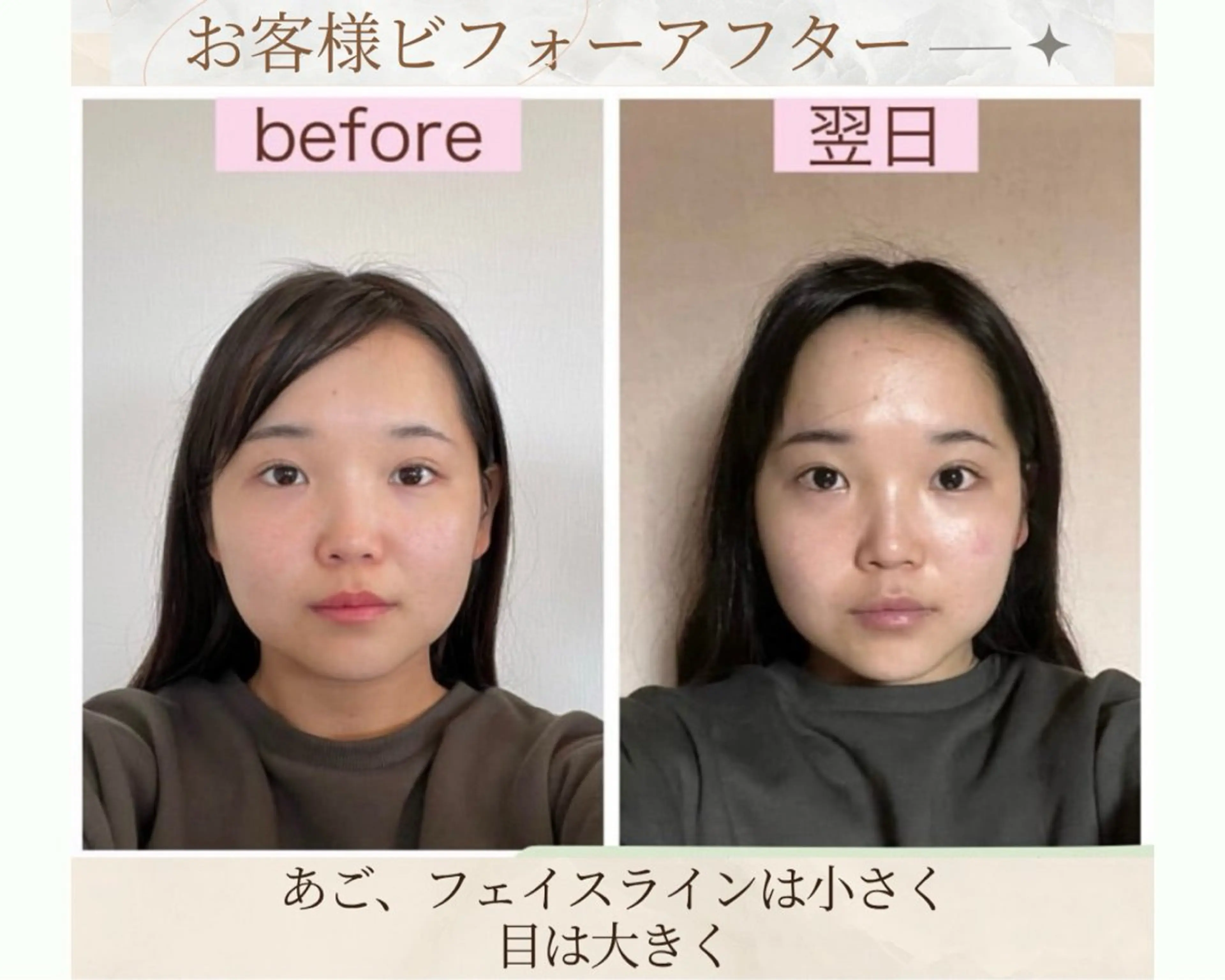 痛くない小顔矯正 いまいあやののその他イメージ