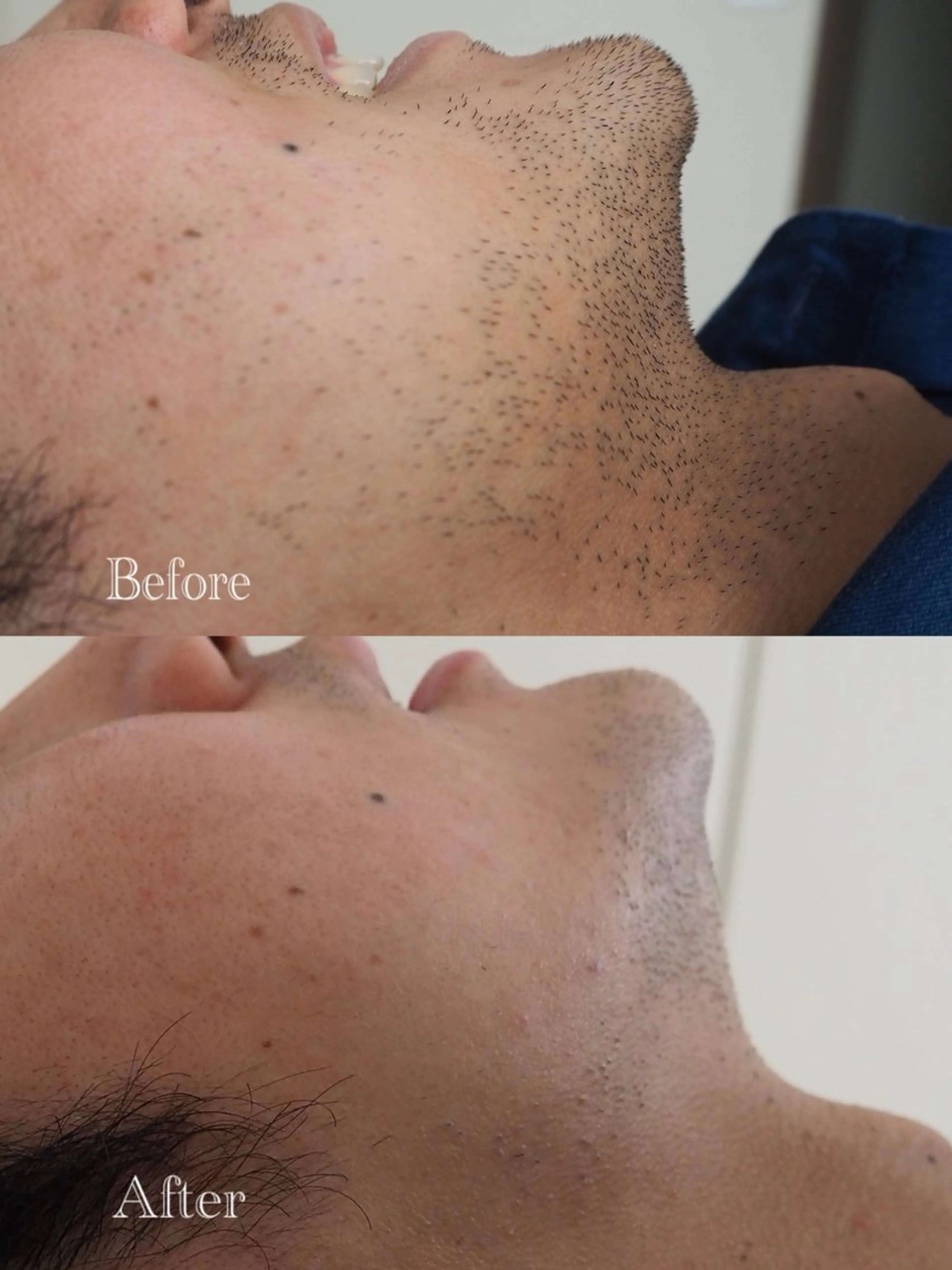 ヒゲ脱毛の写真