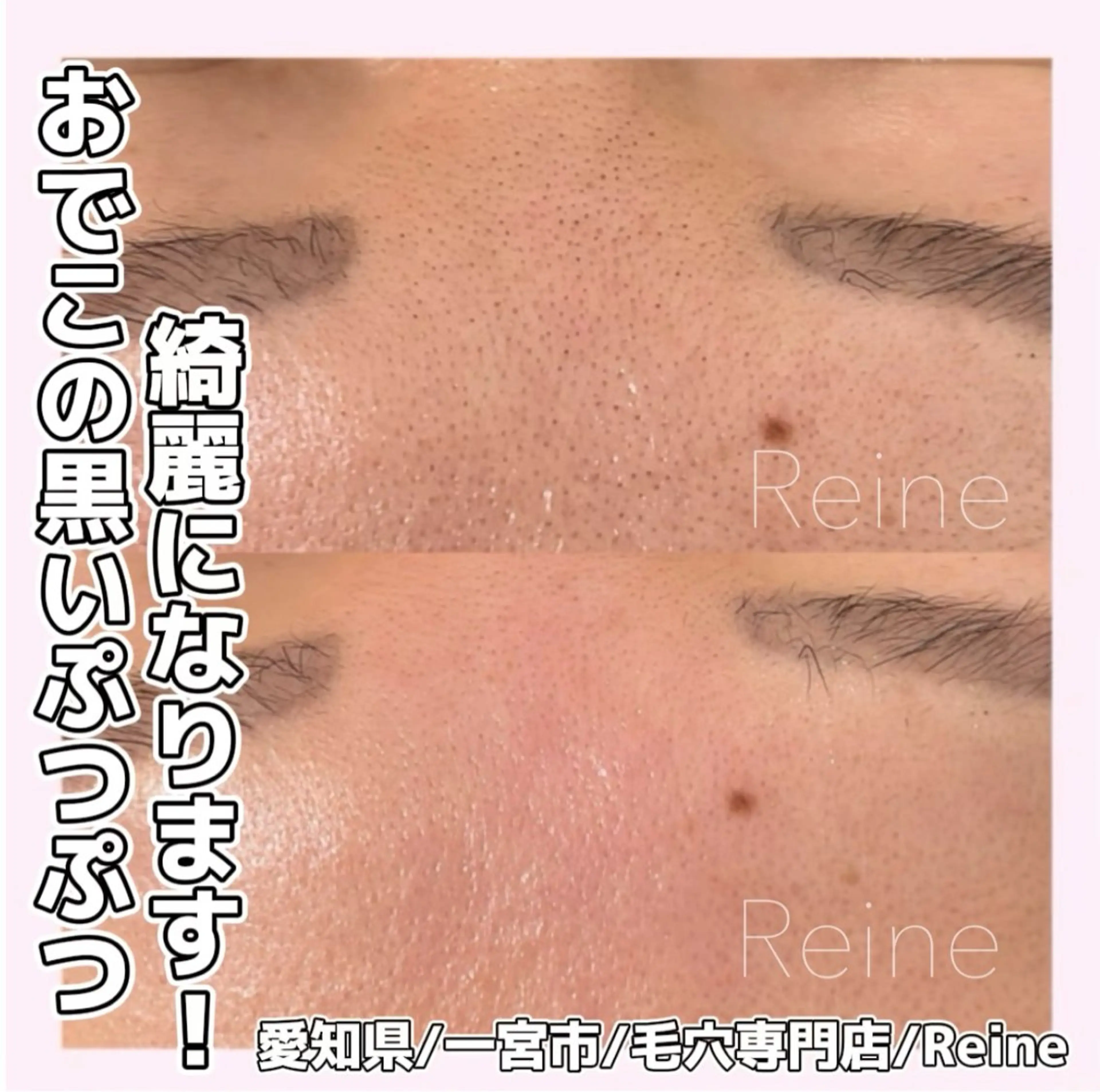 毛穴/シミ肝斑/脱毛 横山梨里のエステ・リラクイメージ