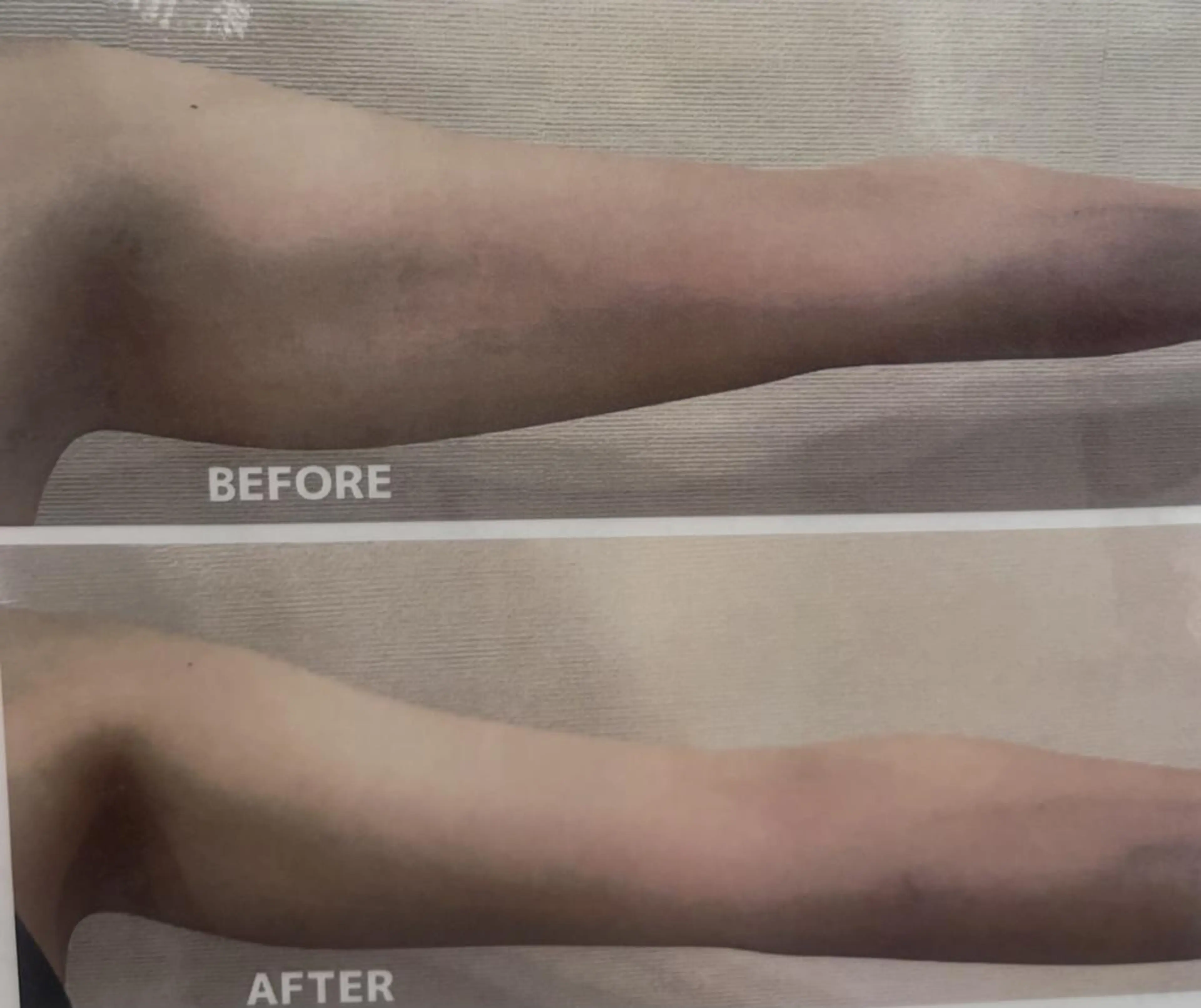 二の腕肩甲骨をスッキリさせて二の腕美人へ☃️❄️自分では出来ないケアして着たい服が着れ、華奢に✨ぜひ一度任せ下さい✨の写真