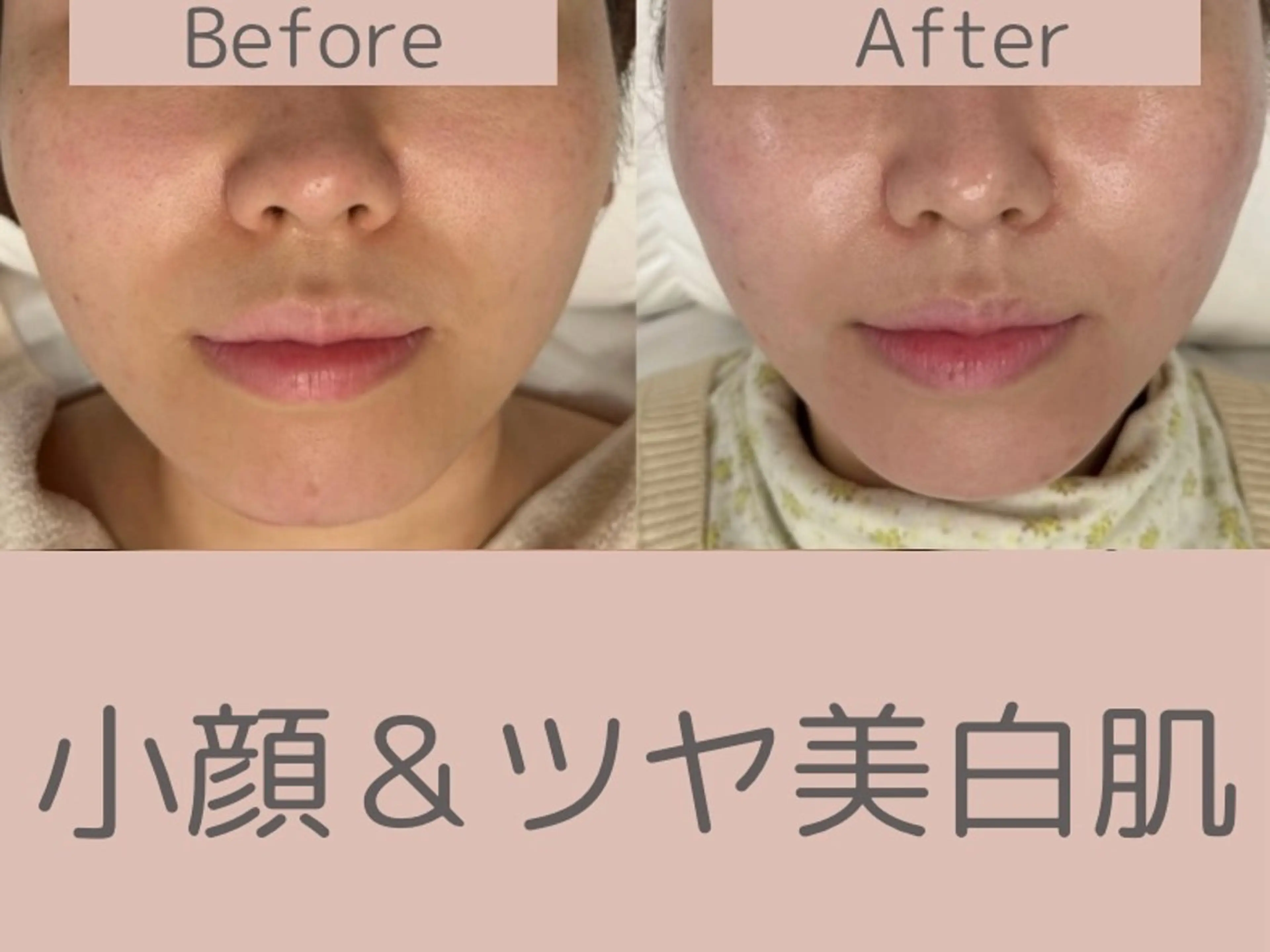 べアール所属・小顔/毛穴/ニキビ salon bealのエステ・リラクイメージ