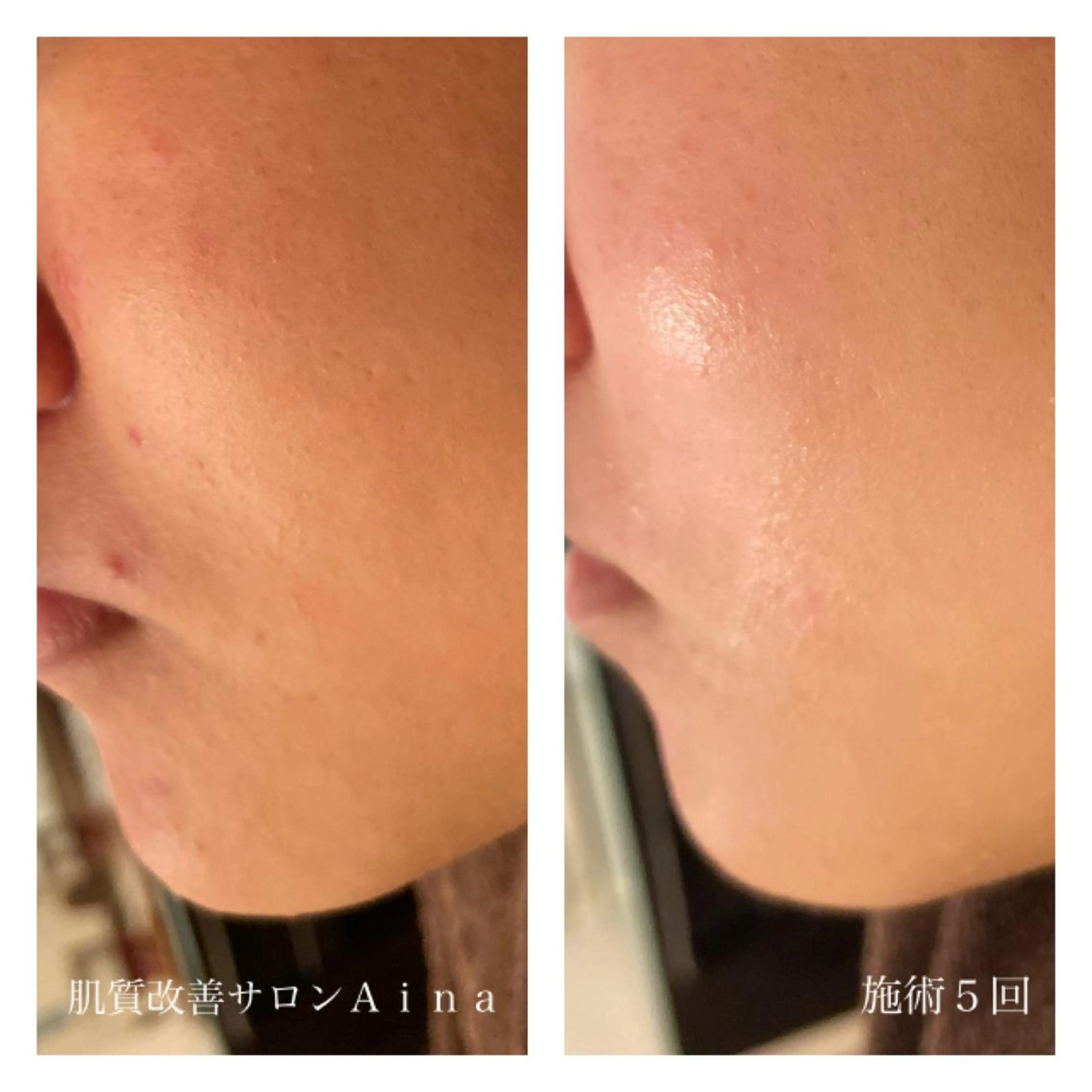 ショート カラー パーマ ヘアアレンジ メンズ キッズ ネイル マツエク・マツパ 透明感カラー エステ リラク ニキビ跡専門サロン Ａｉｎａのエステ・リラクイメージ