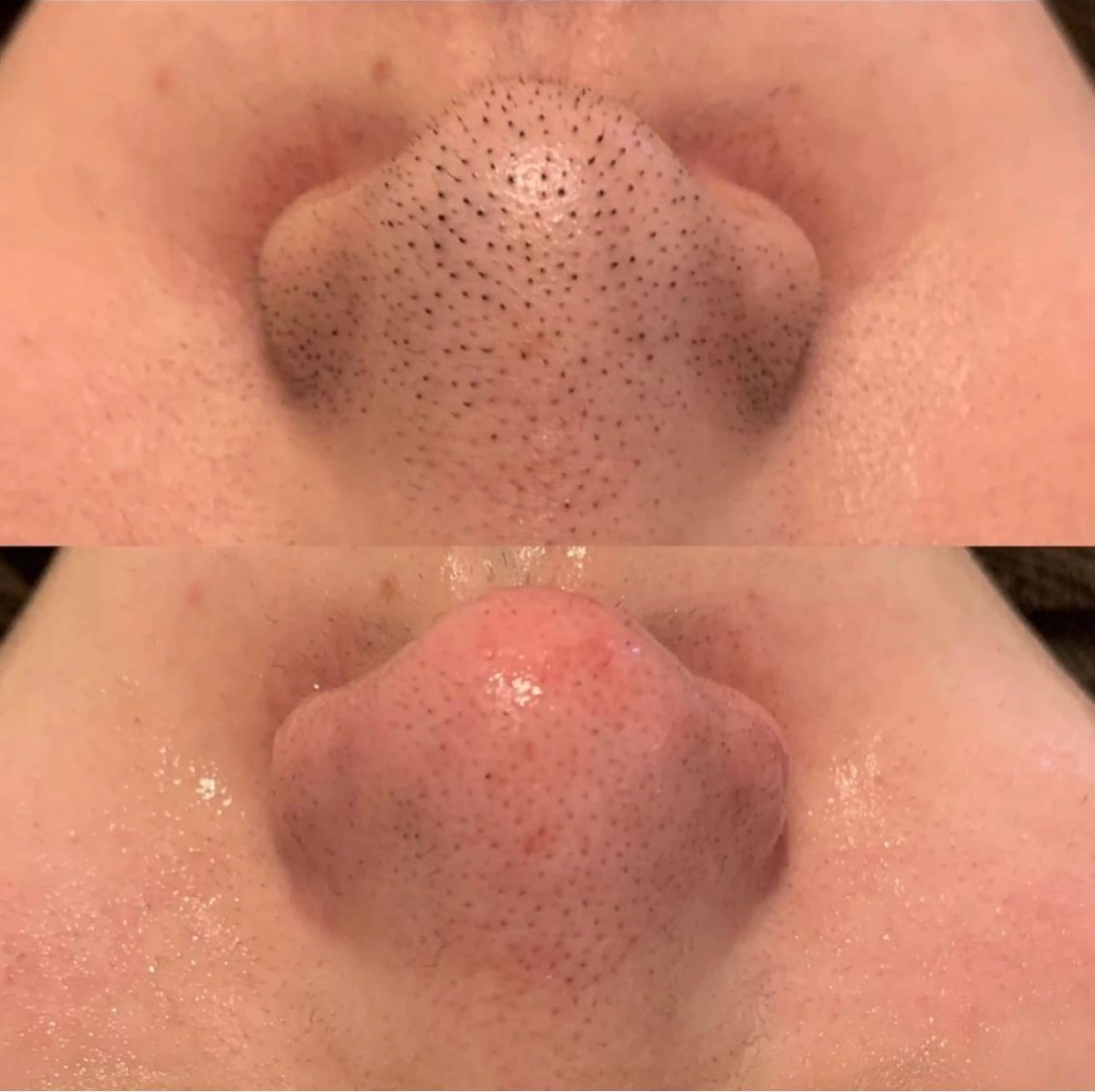 毛穴エクストラクション＋エレクトロクレンジング＋パック＋導入（デコルテマッサージ付）👃🏼の写真