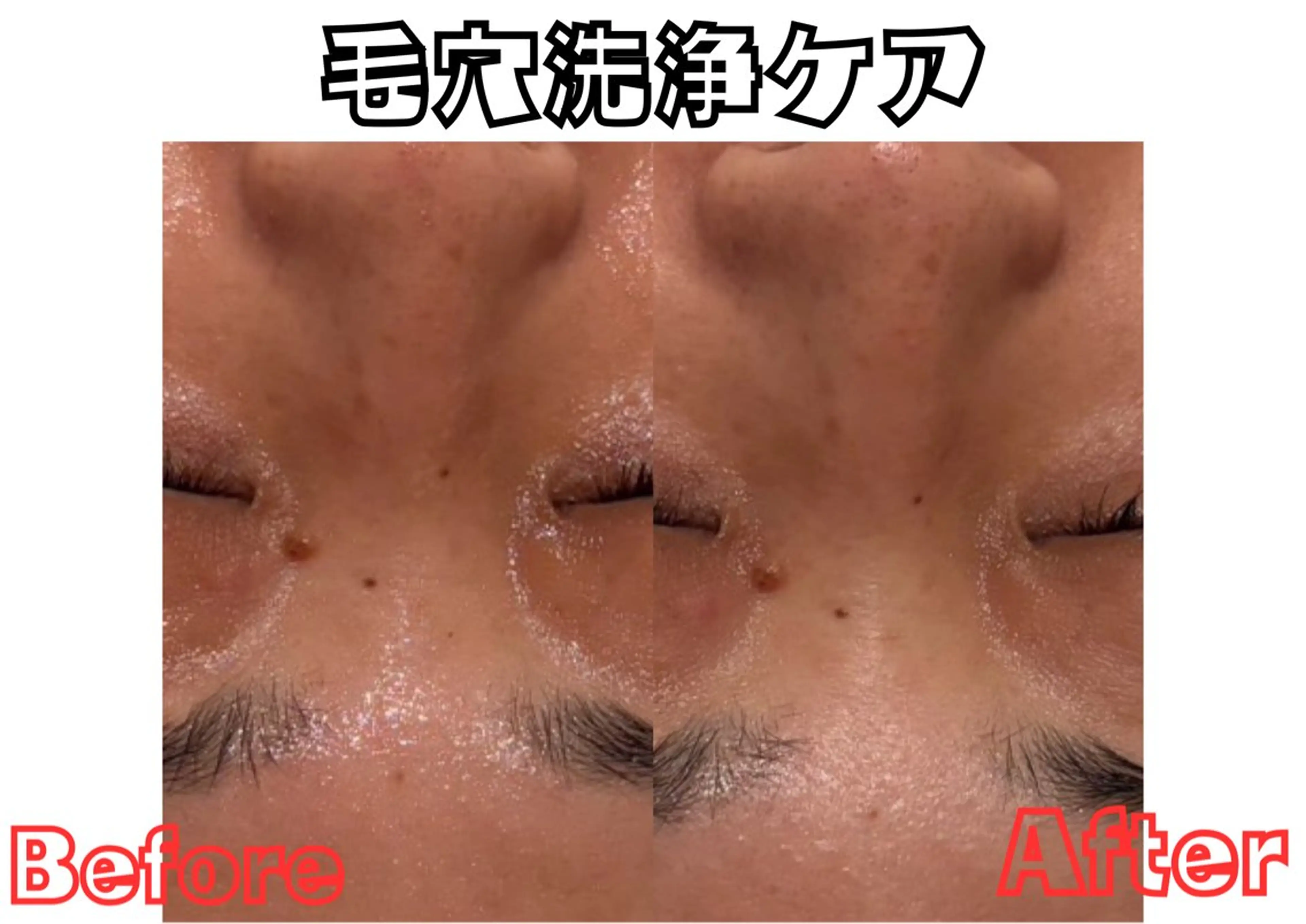 【5名限定！！】毛穴掃除付き！フェイシャルエステ♡の写真