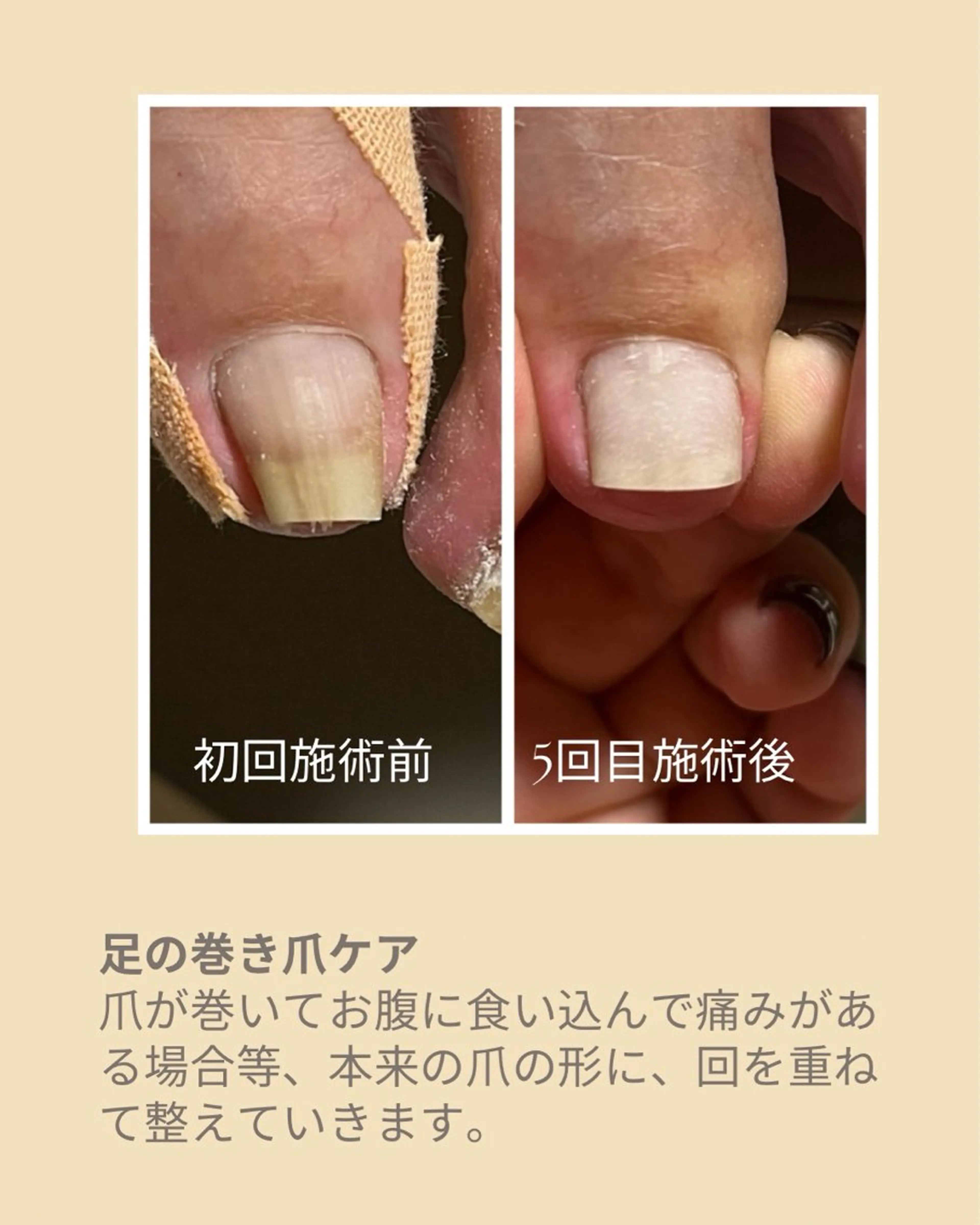 ネイル フットネイル ダンラップ新里 友簣乃のネイルデザイン