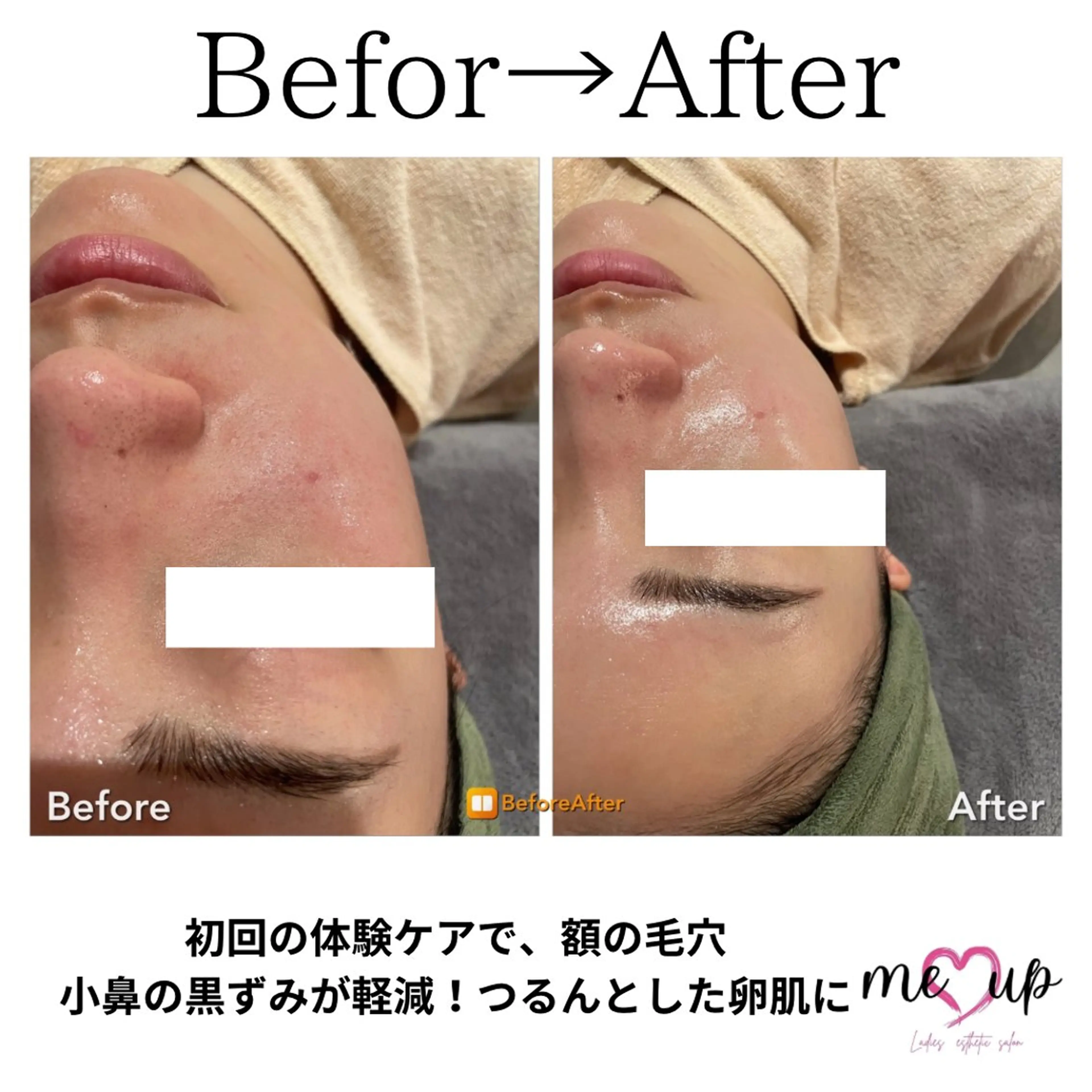 エステ Meupニキビ専門店 背中/ハーブ/肌管理のその他イメージ