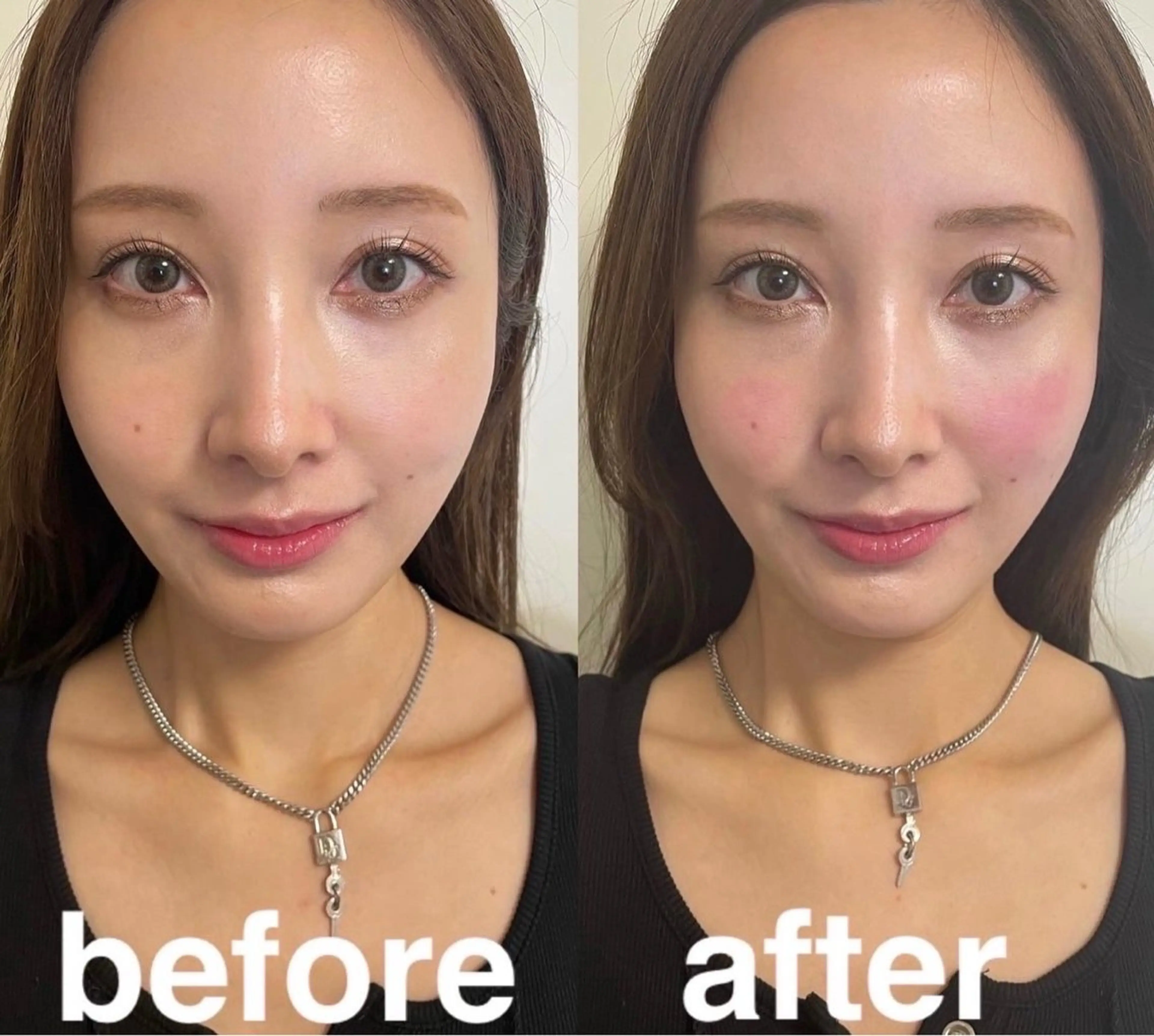 🉐平日限定⚡️最強変化⚡️浮腫んだお顔をスッキリ😆❣️14550円→8000円【電気美容鍼＋頭皮鍼＋頭首マッサージ】の写真