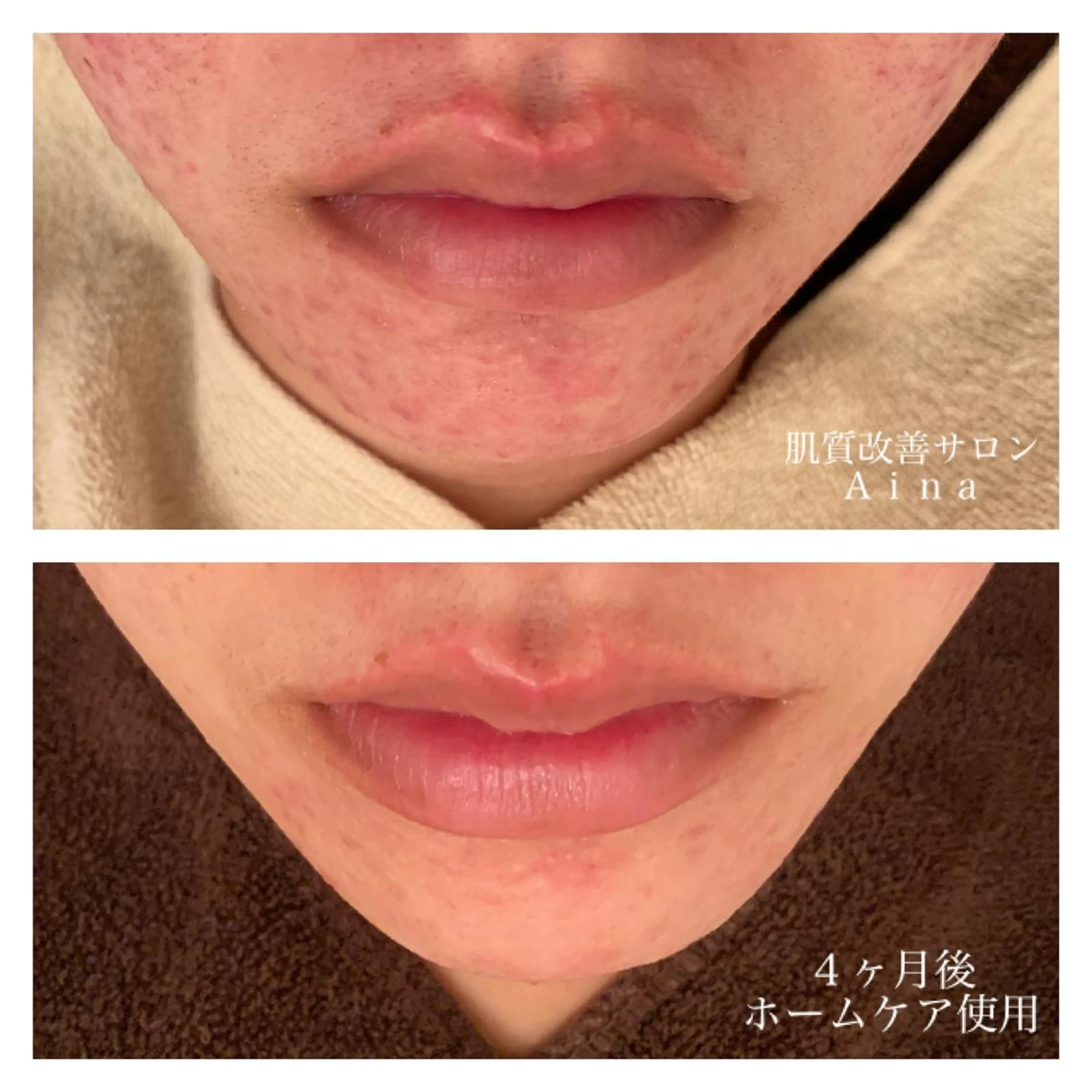 ミディアム カラー パーマ ヘアアレンジ メンズ キッズ ネイル マツエク・マツパ 赤色 ニキビ跡専門サロン Ａｉｎａのエステ・リラクイメージ