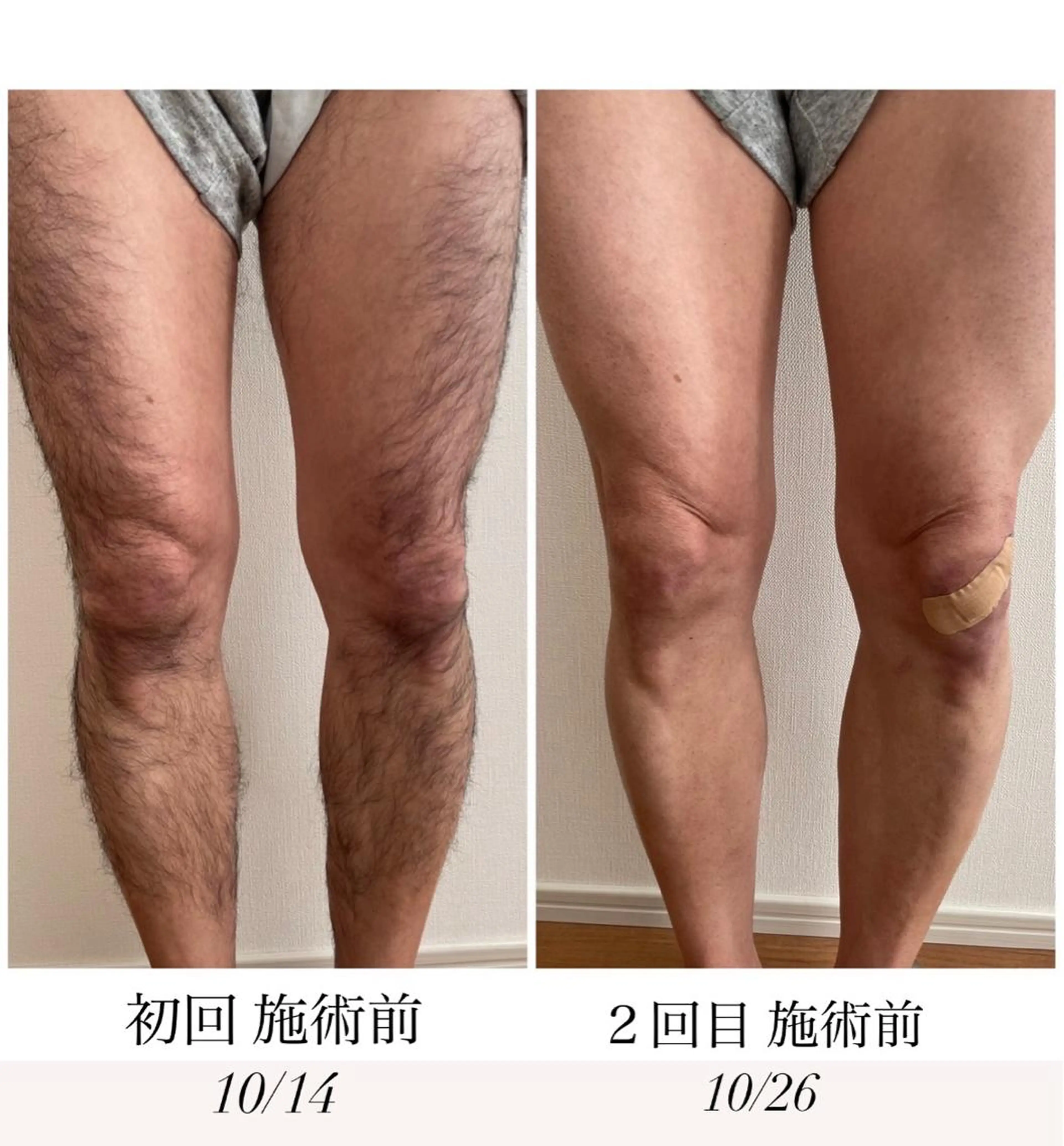 【MEN'S 足脱毛】腿から足の指毛までツルンツルン🤭の写真