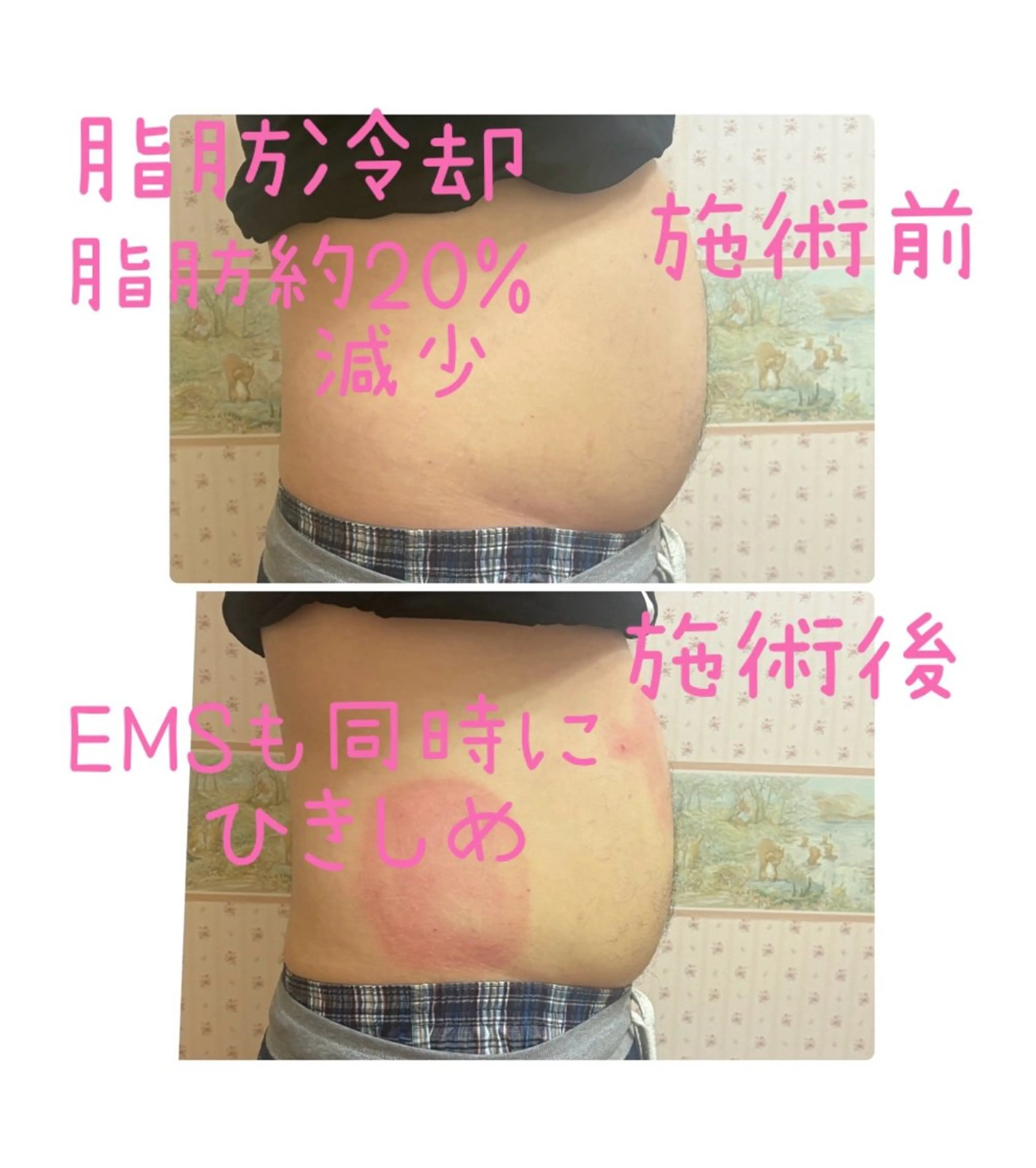 冷却スリミングケア4部位の写真