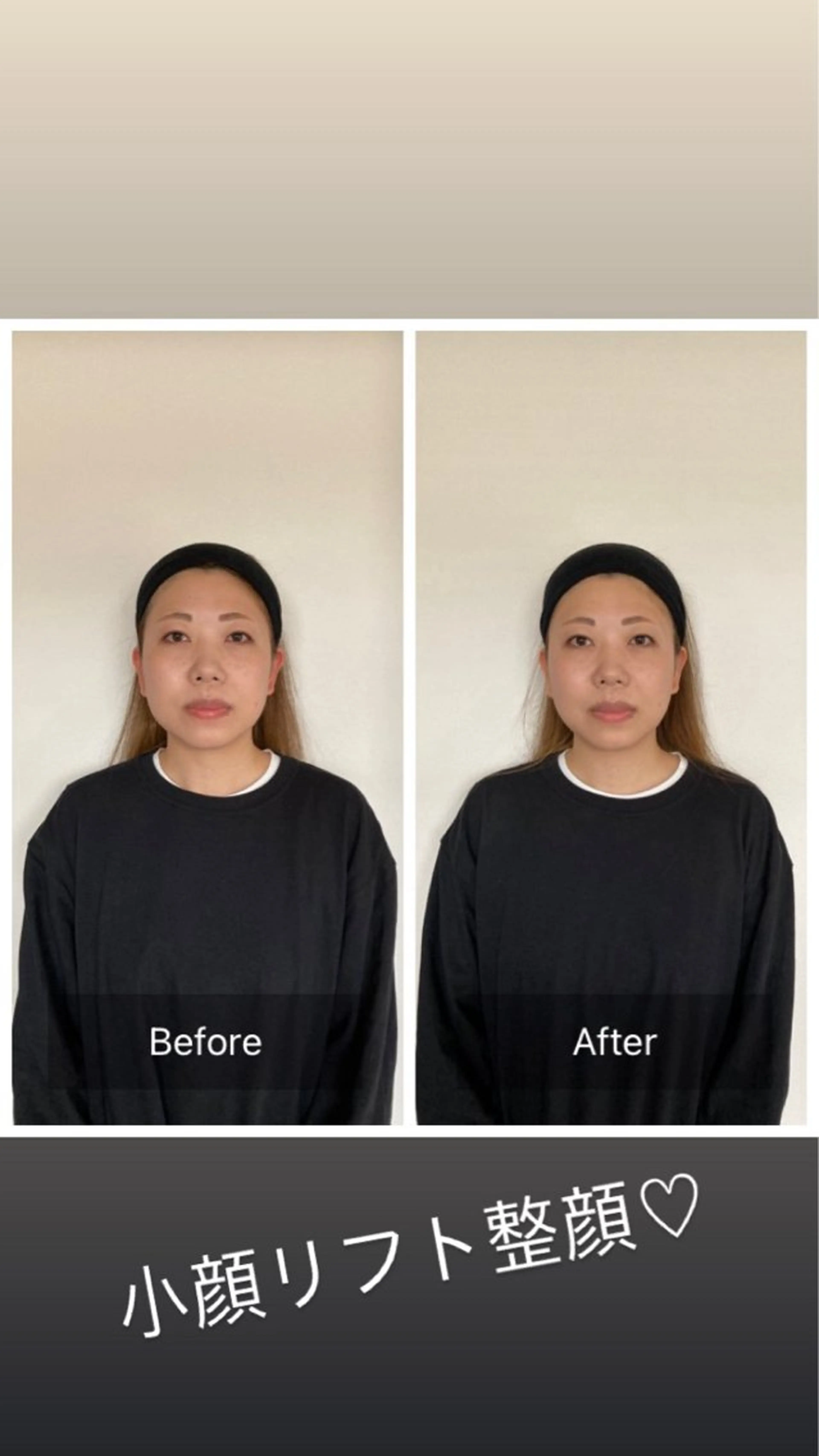 1回で変化がわかる小顔矯正/たるみ、浮腫み、リフトアップの写真