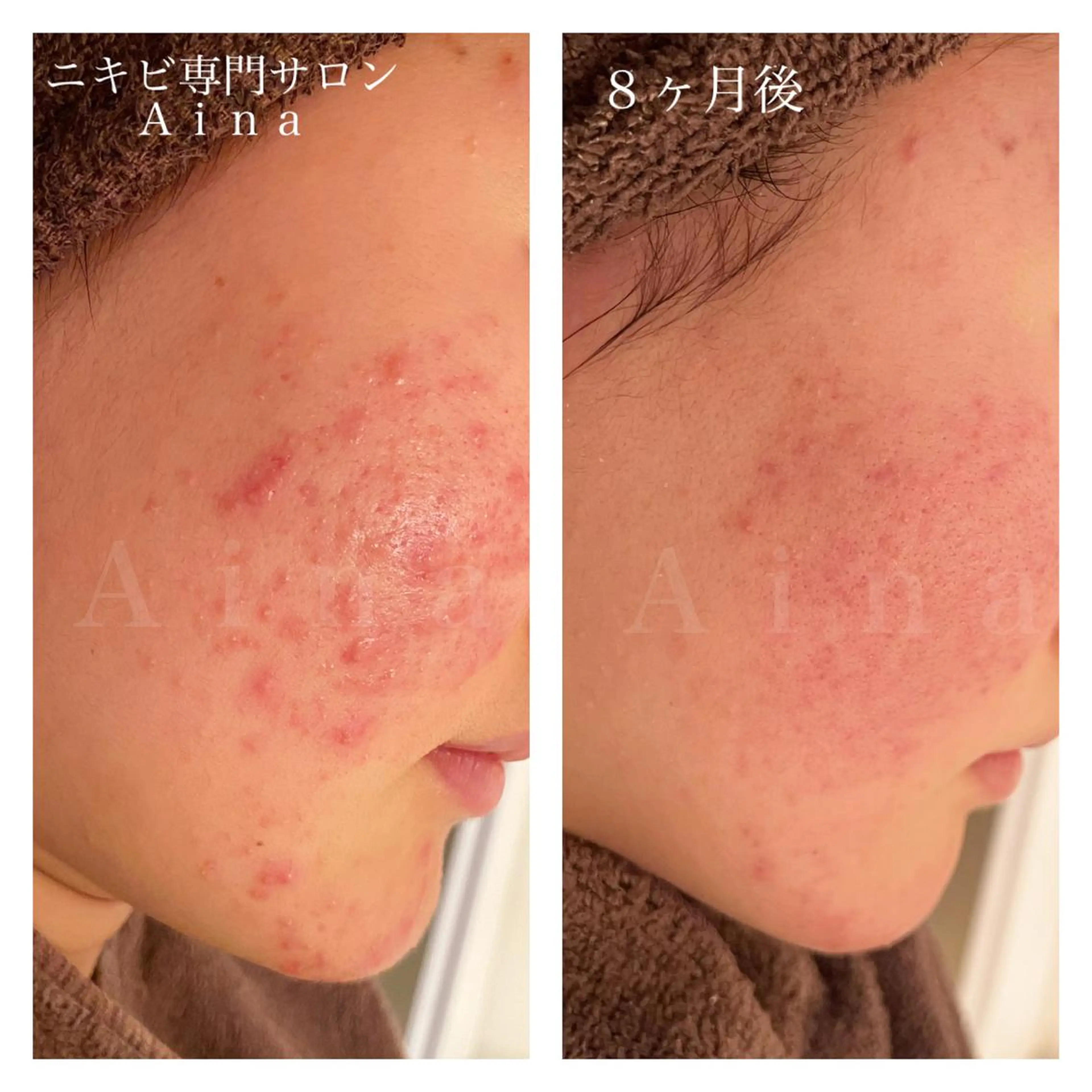 セミロング パーマ ヘアアレンジ メンズ キッズ ネイル マツエク・マツパ アイブロウ エステ リラク ニキビ跡専門サロン Ａｉｎａのエステ・リラクイメージ