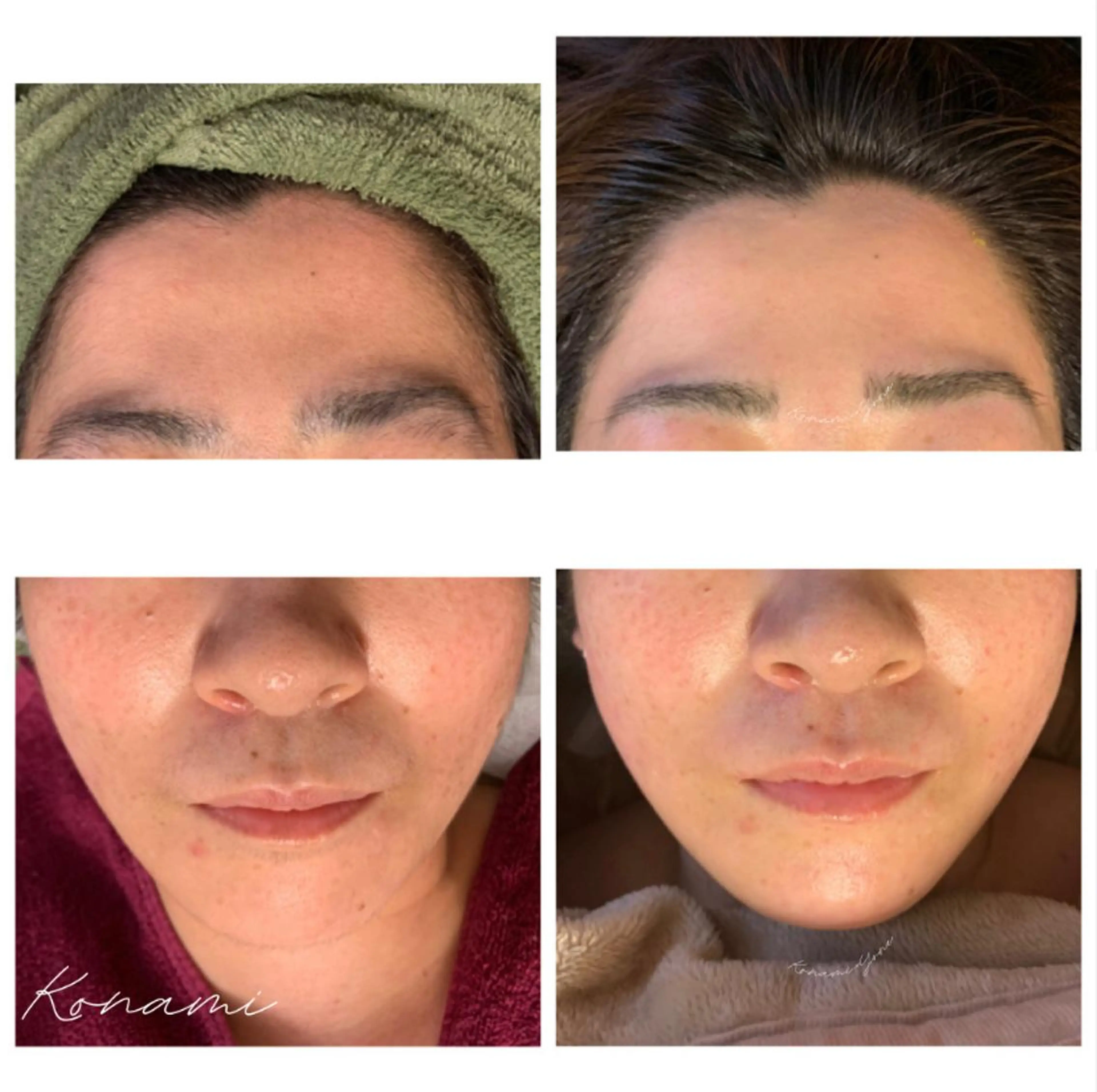 【WAX脱毛】フェイスワックスの写真