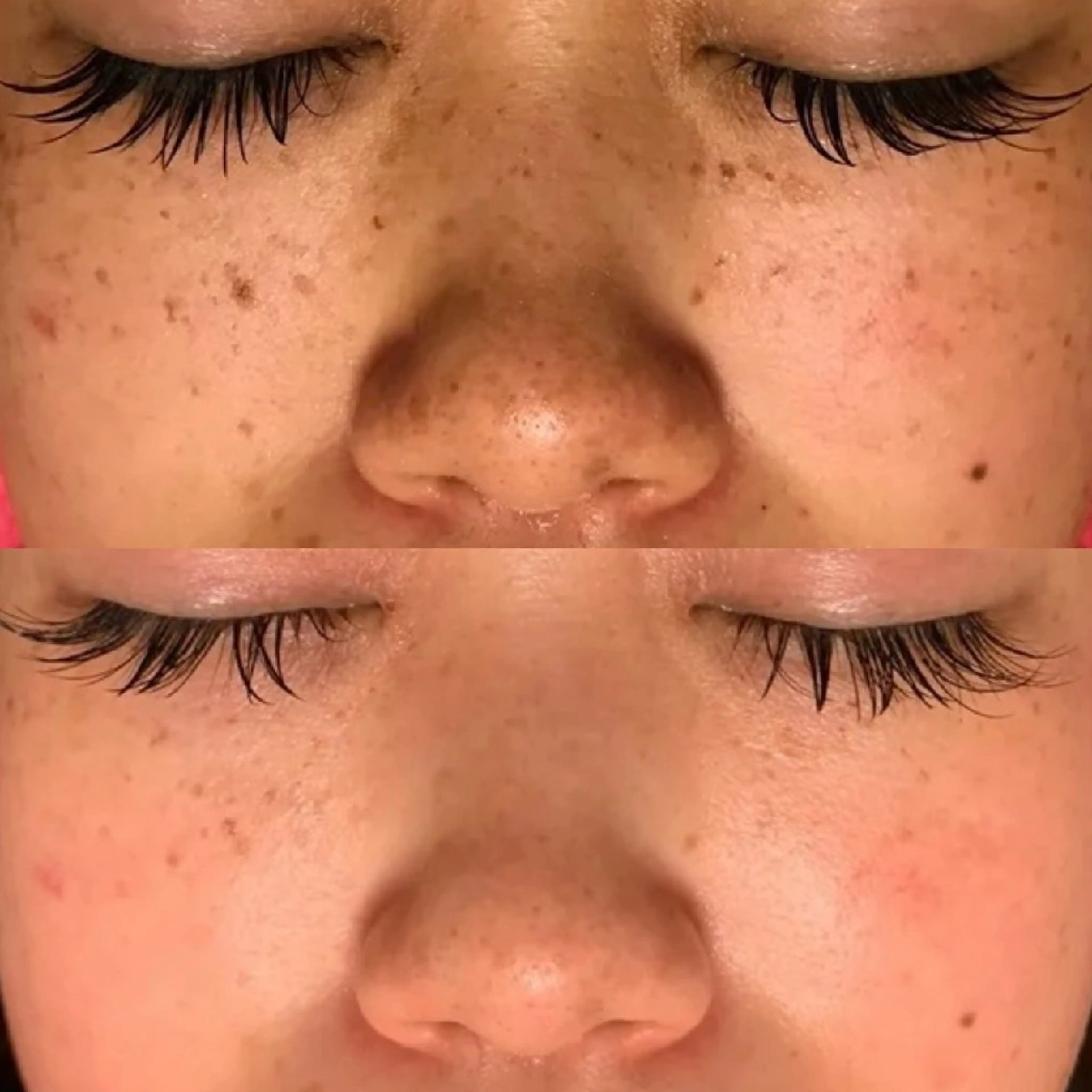 【期間限定価格🉐】《ニキビ跡/シミ/赤み改善》光フォト+超音波毛穴洗浄の写真