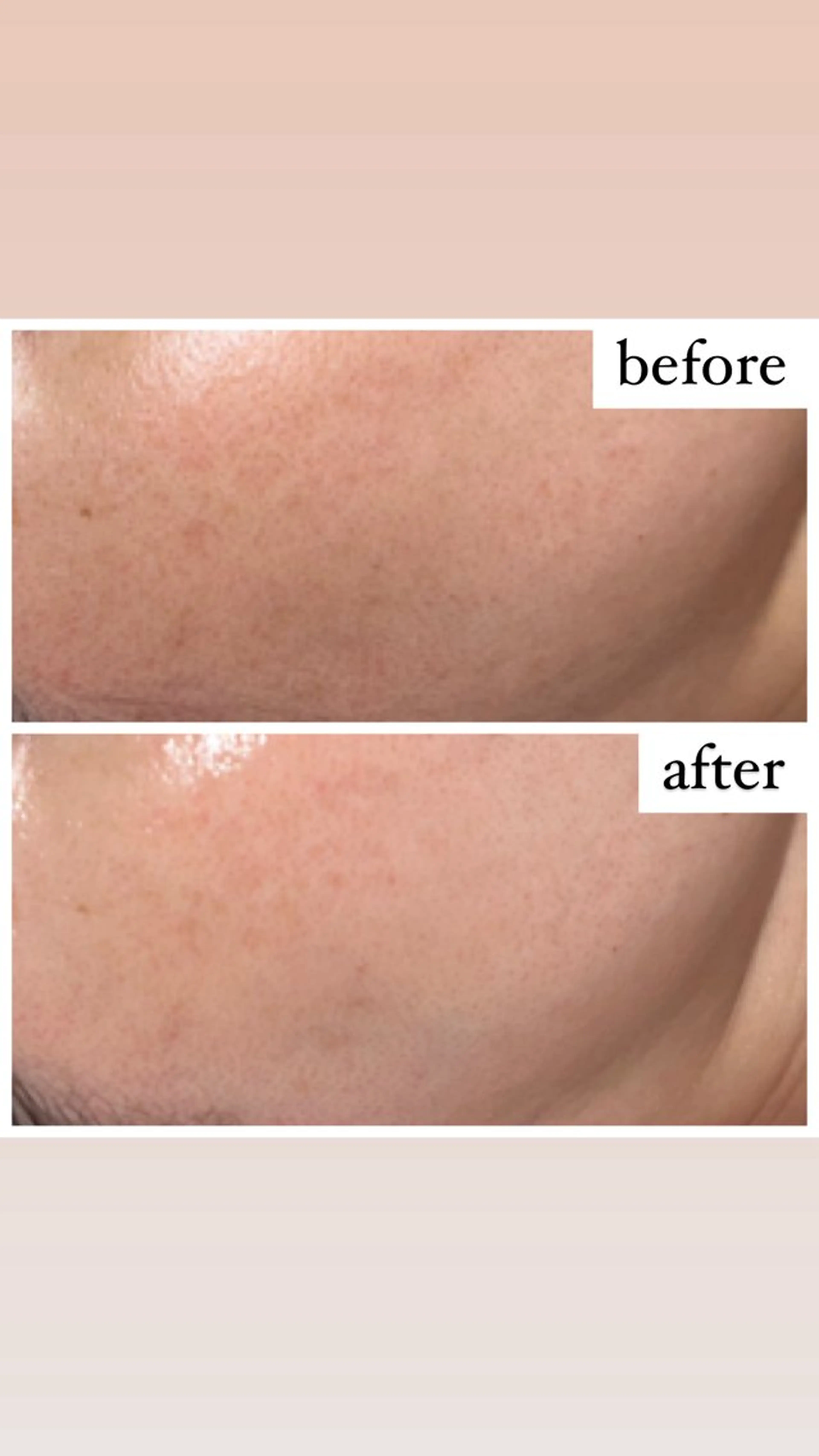 エステ 【ハーブピーリング】 Allumentのエステ・リラクイメージ