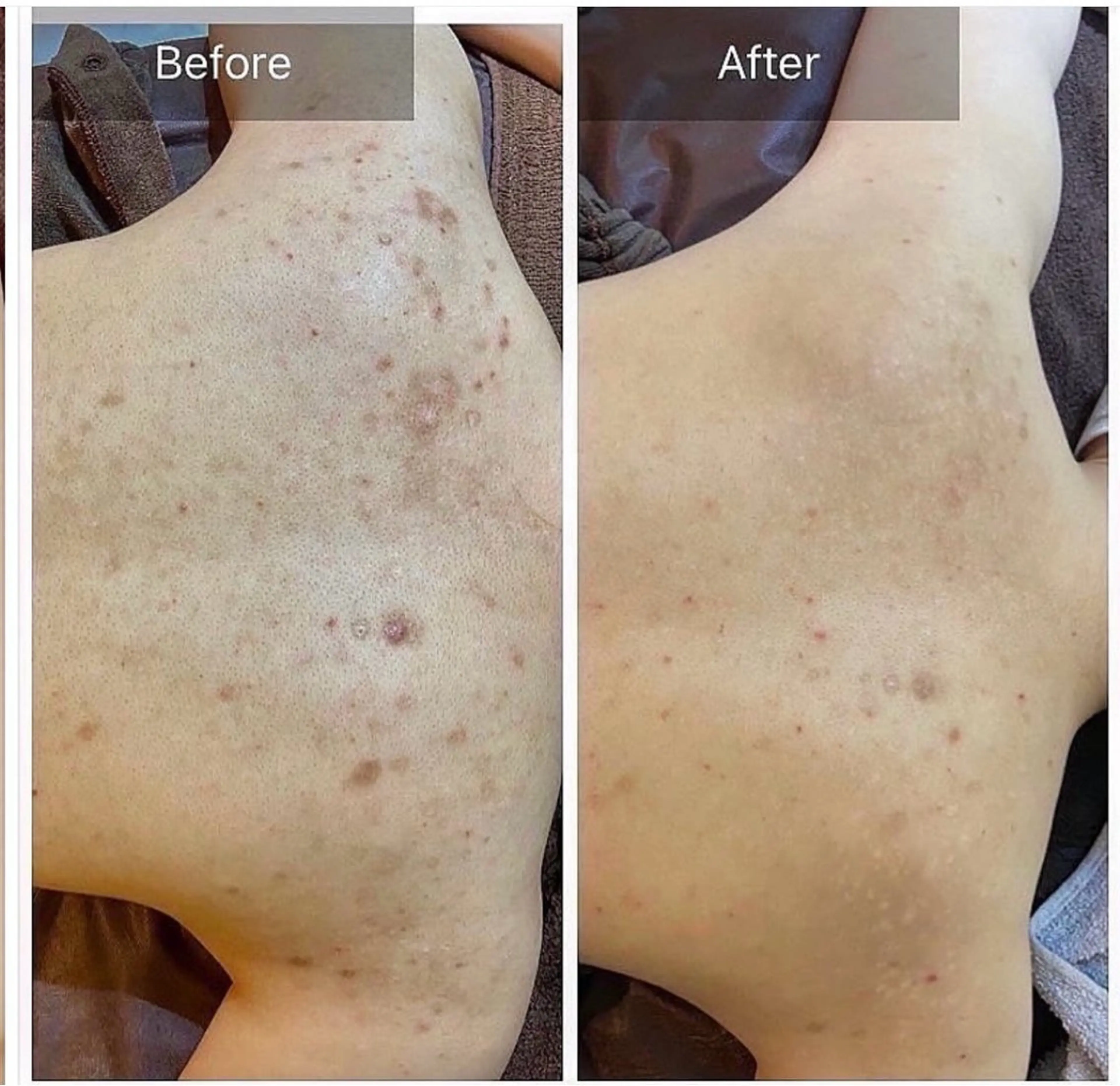 ニキビ・ニキビ跡🌿 ハーブピーリング✨のその他イメージ