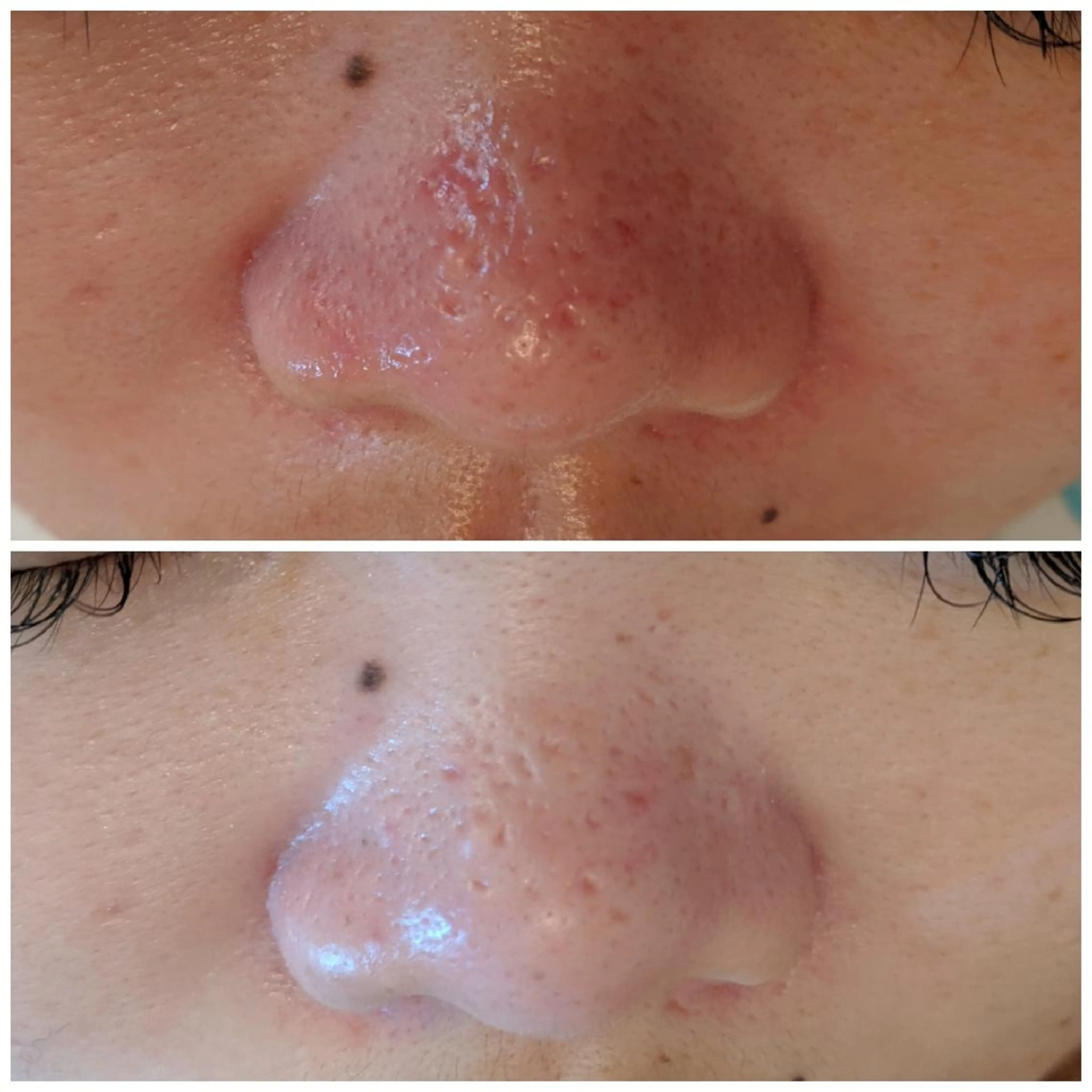 【赤ニキビ改善】 BELL'ET新宿店のエステ・リラクイメージ