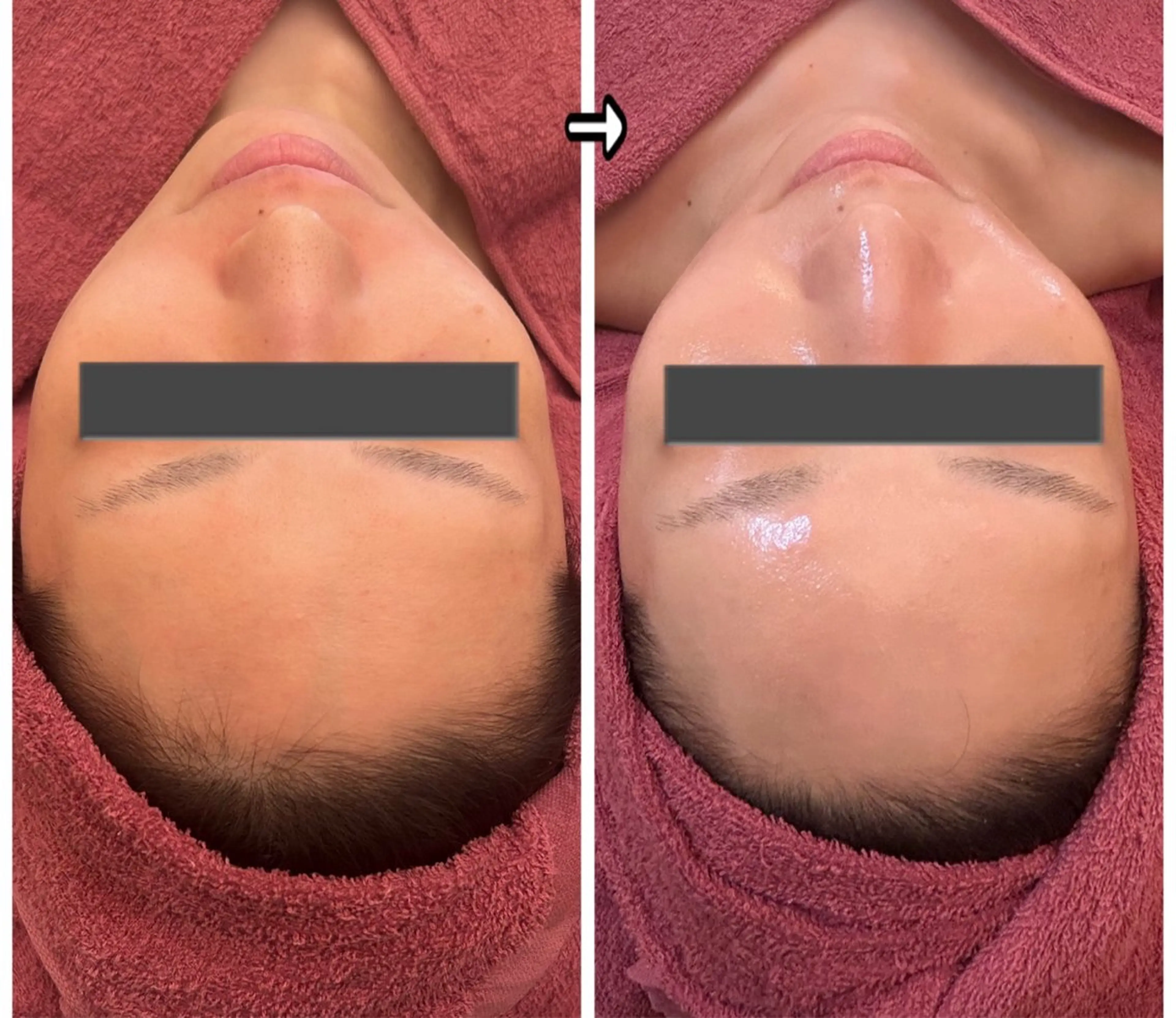 エステ ハーブピーリングMB eautySalonのエステ・リラクイメージ