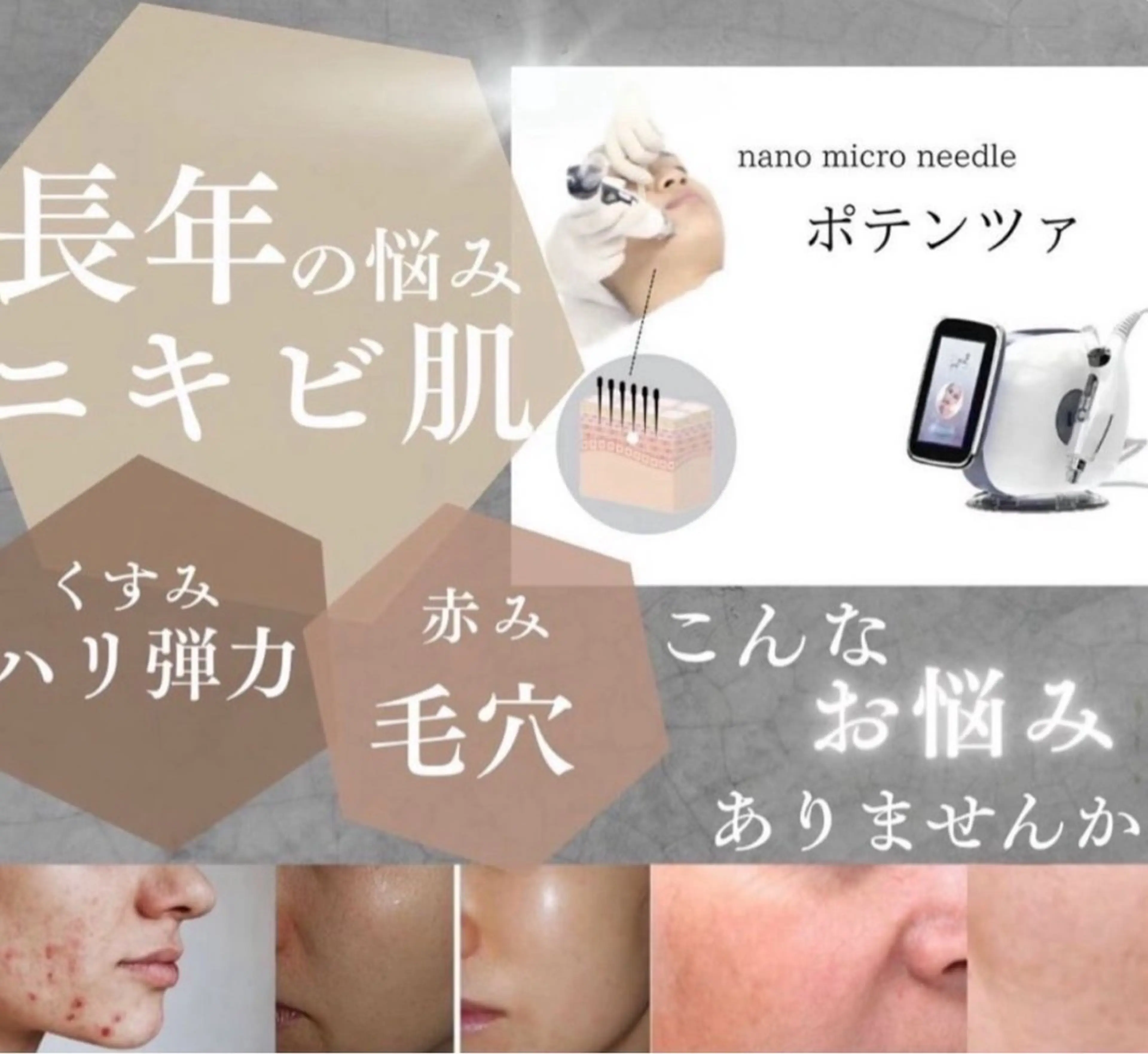 💎エステポテンツァ💎ニキビ/ニキビあと/毛穴/透明感/シワ/ハリ弾力の写真