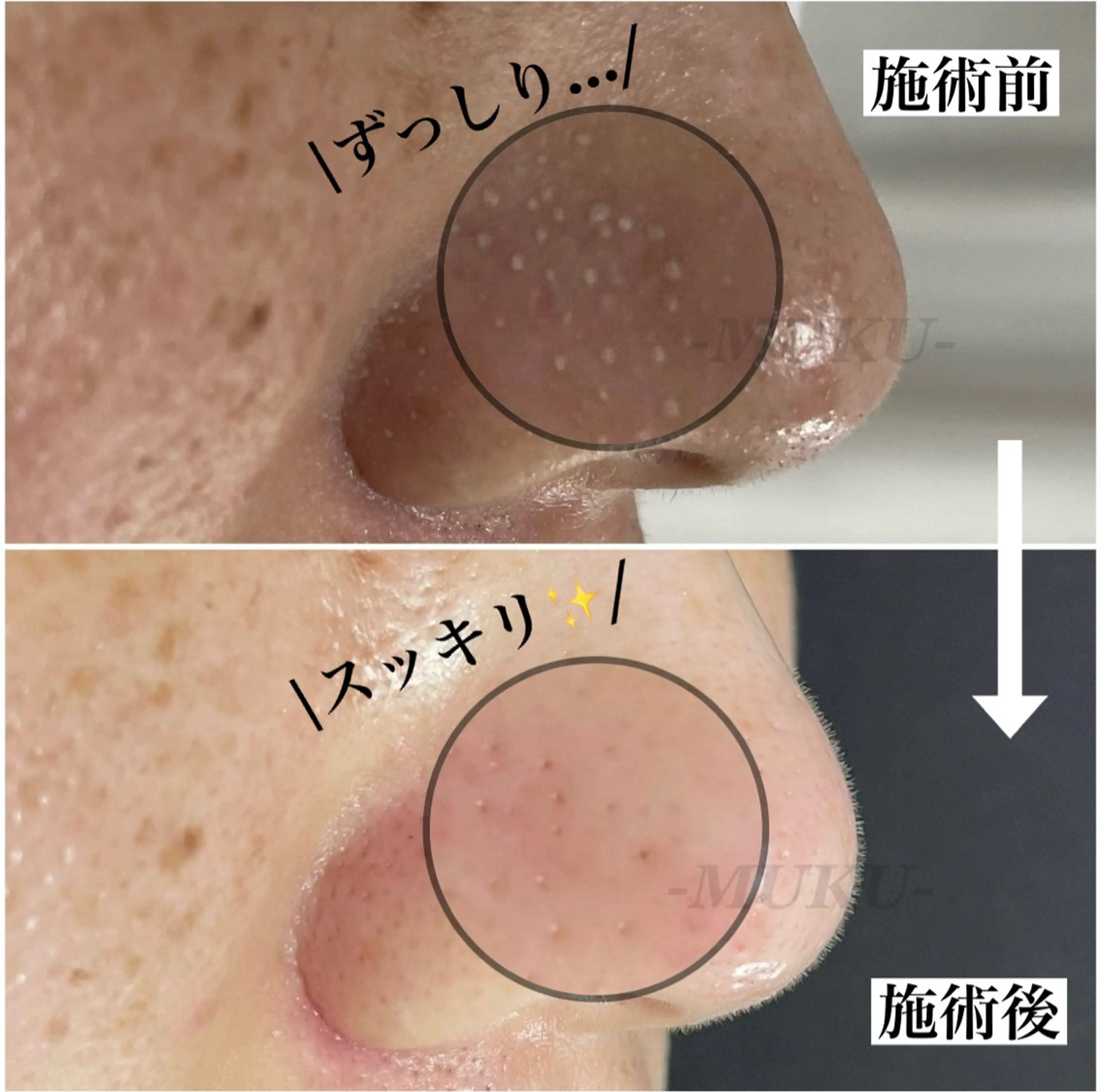 毛穴レスコースの写真