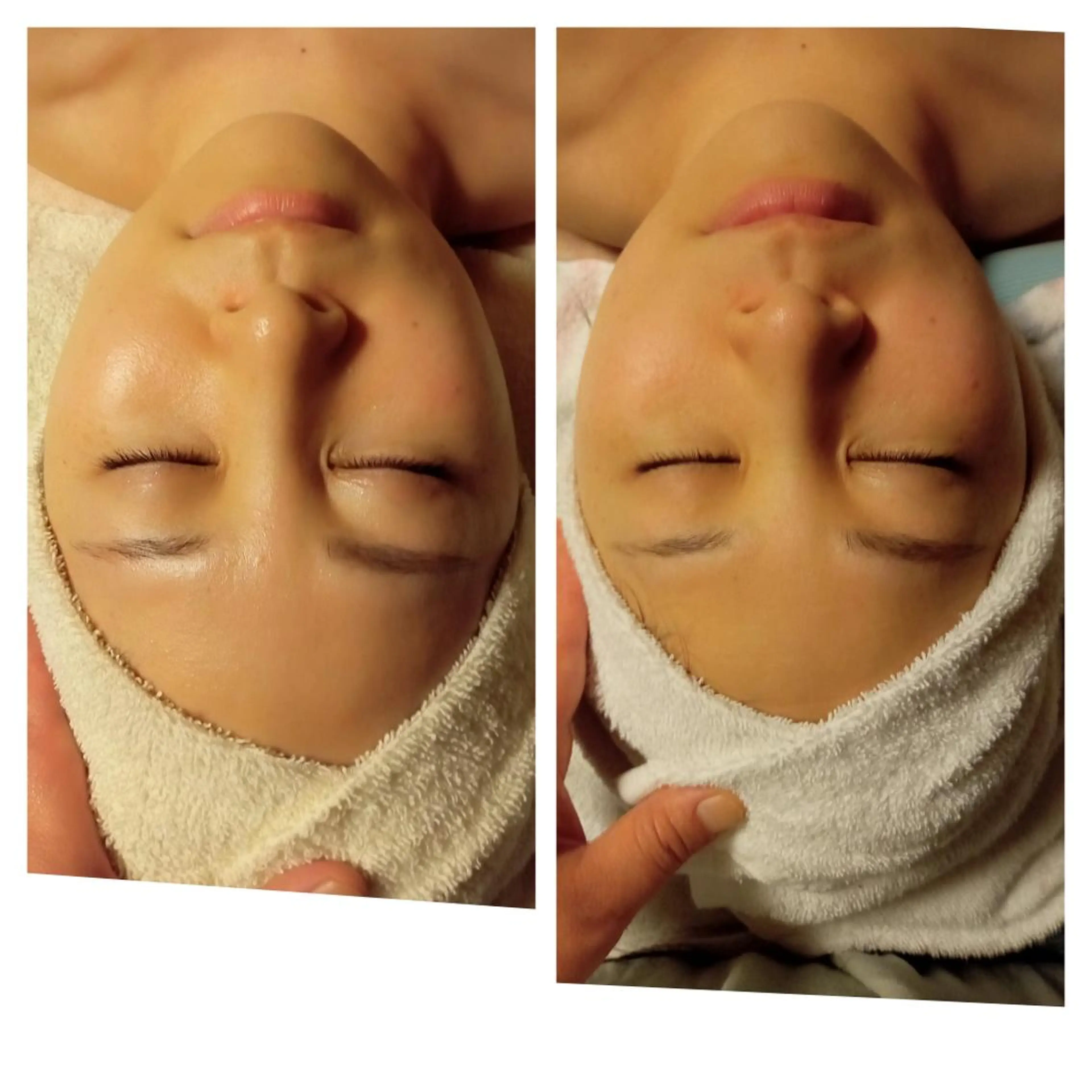 リフトアップフェイシャルの写真