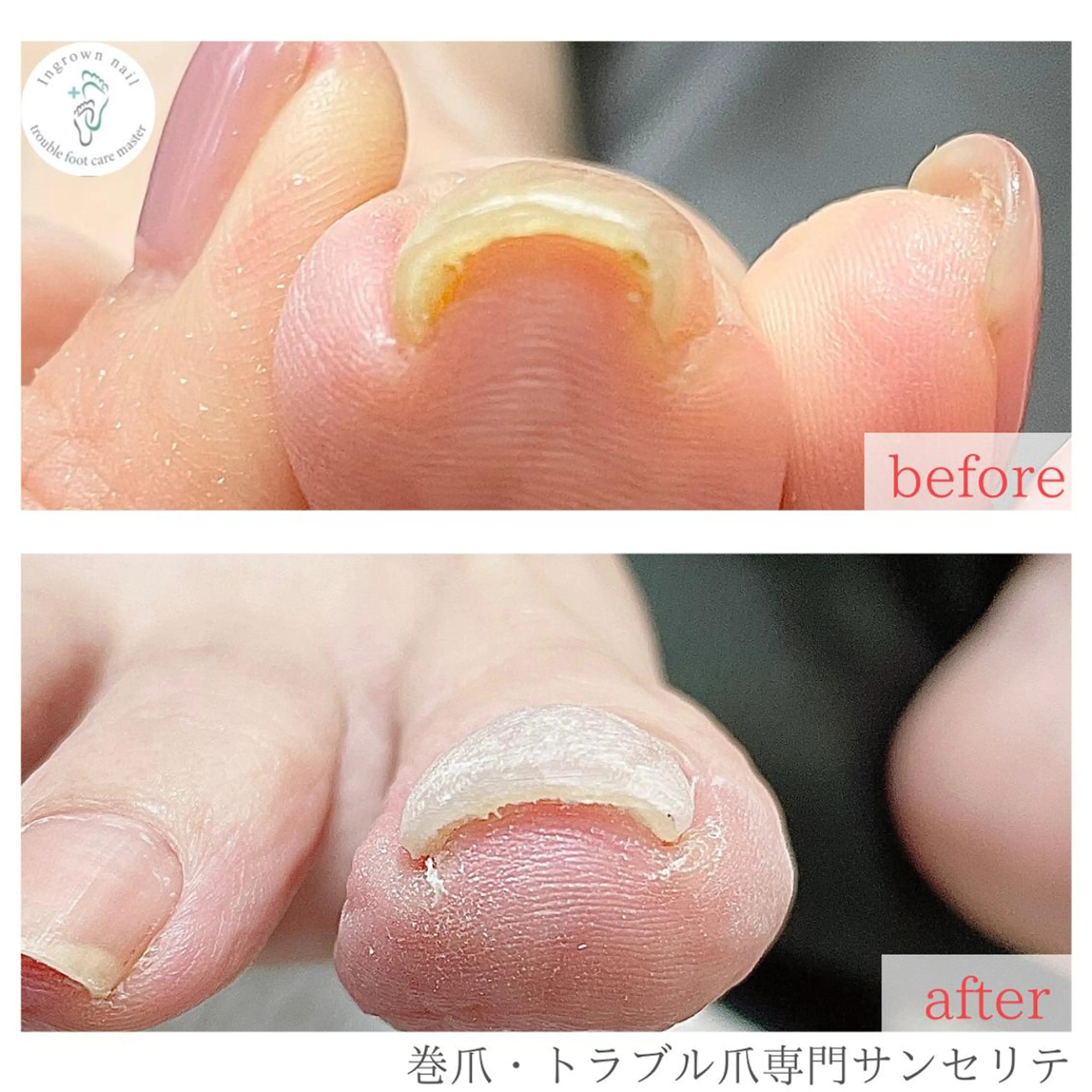 ネイル 深爪・巻き爪 専門サンセリテのネイルデザイン