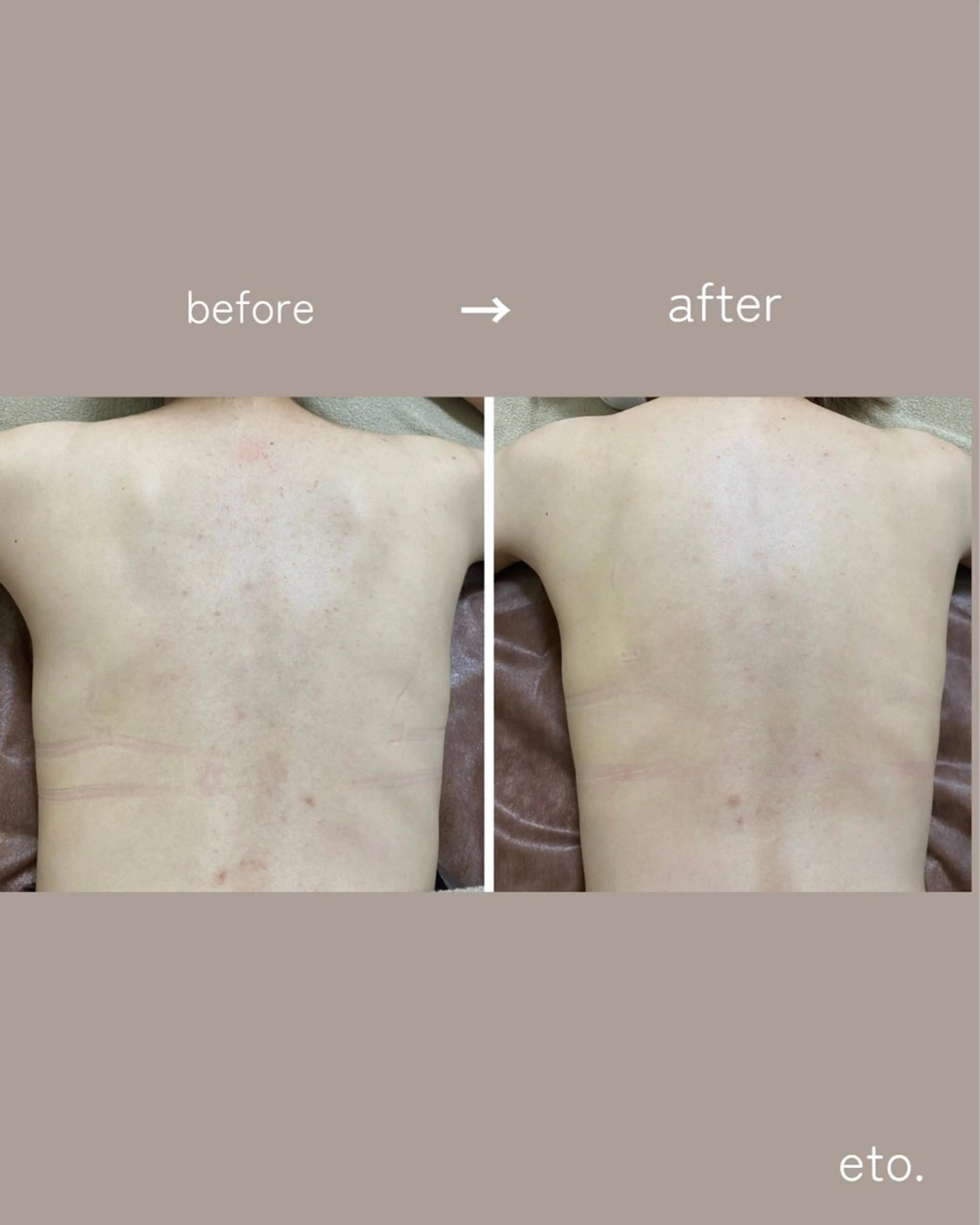 肌質改善サロンeto ニキビ・ニキビ跡のエステ・リラクイメージ