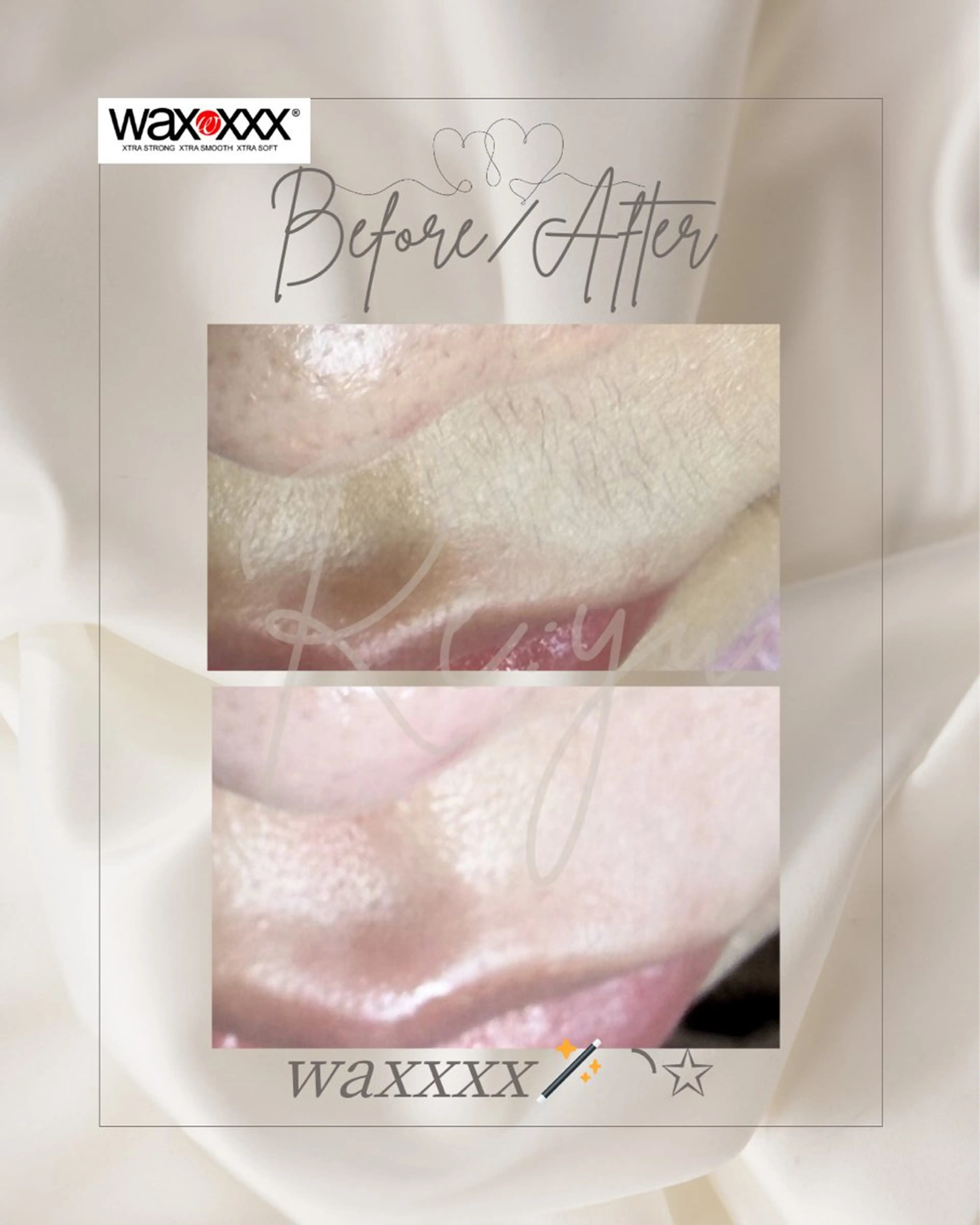 鼻下wax脱毛の写真