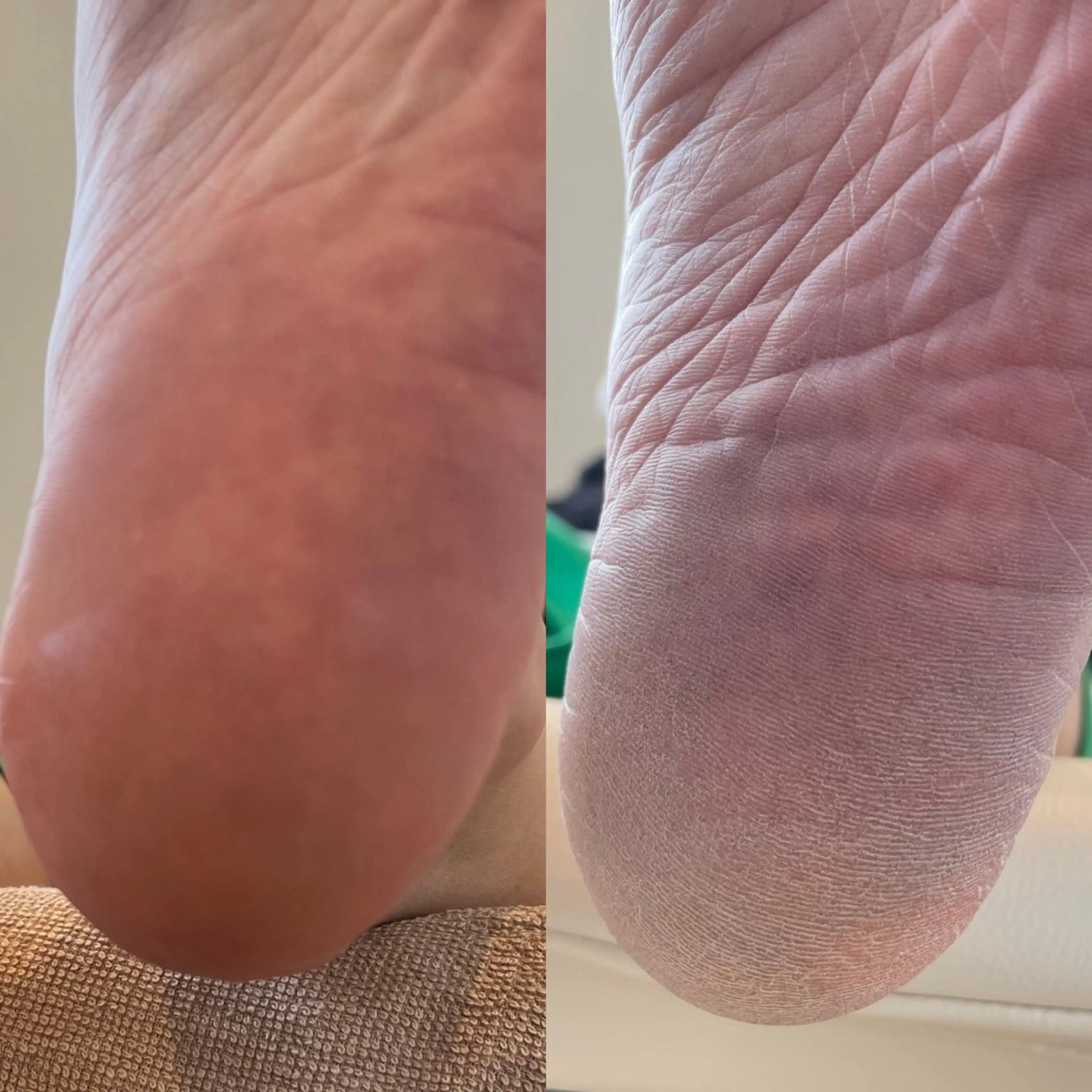 フットスペシャルケア【かかと角質ケア付き】の写真