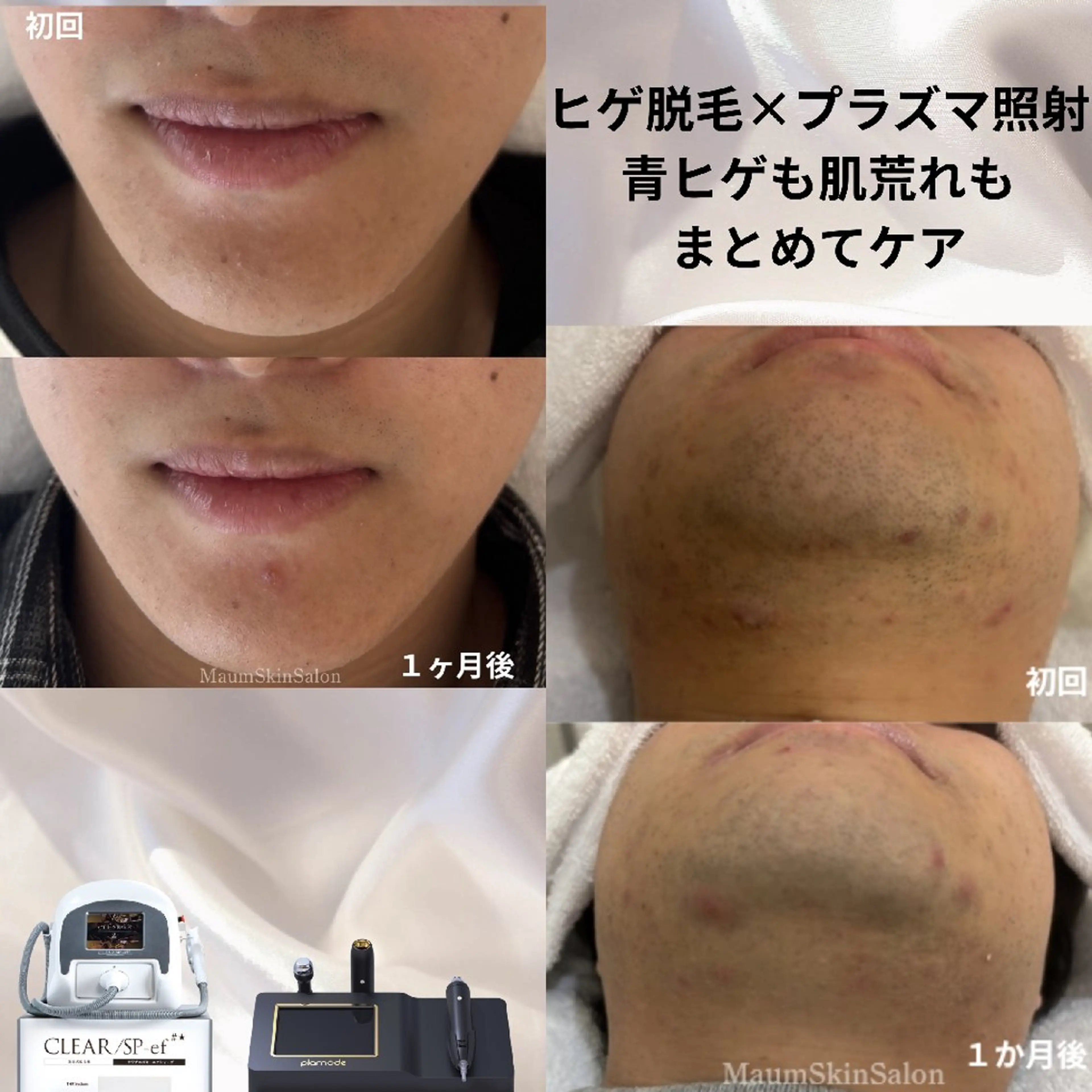 【メンズヒゲ脱毛】SNS掲載OKな方のみ(美肌ケアあり)の写真