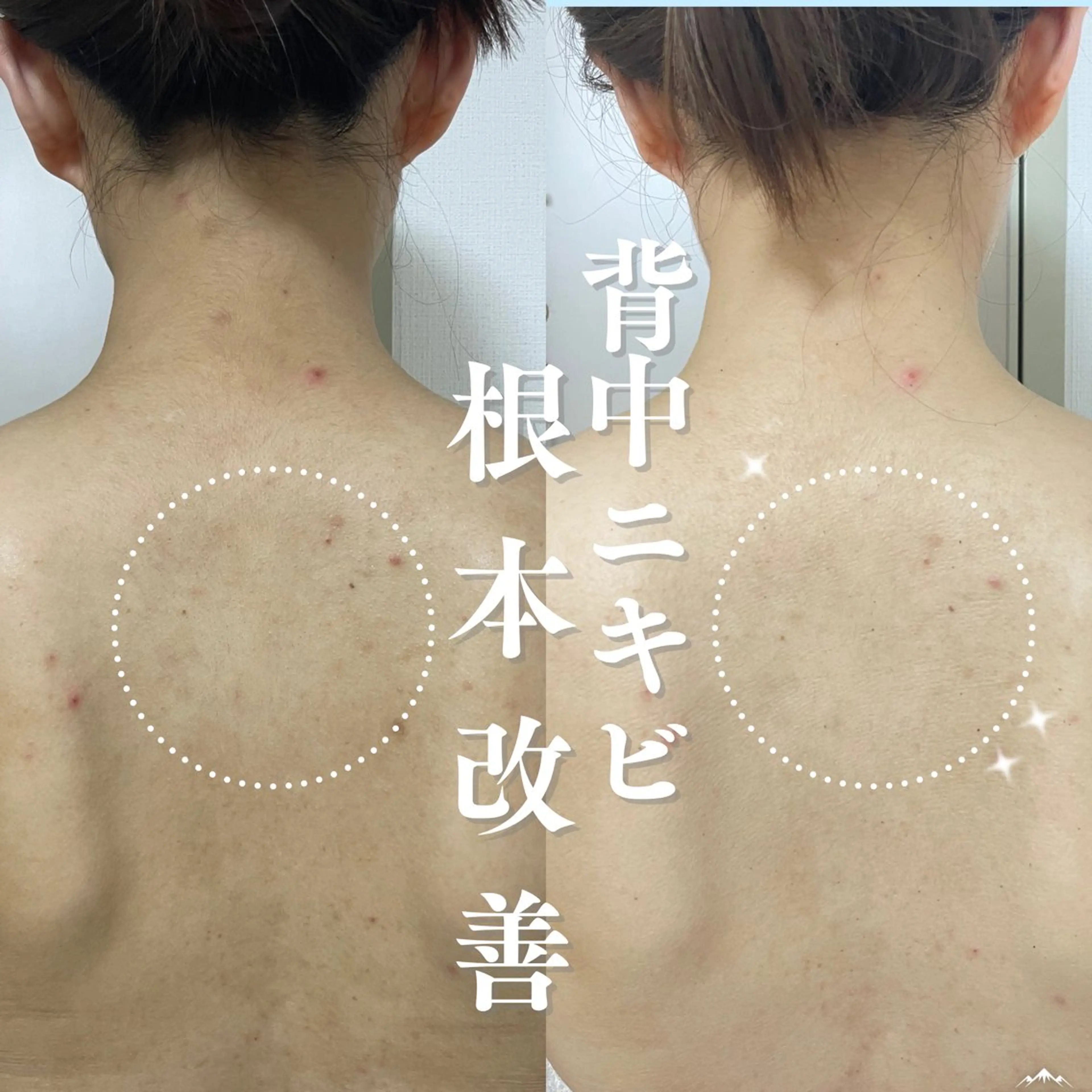 【背中ニキビケア🌿】剥けないハーブピーリングピーリング(肩​〜​腰までしっかり)＋美容液導入付き　定価22,000円の写真