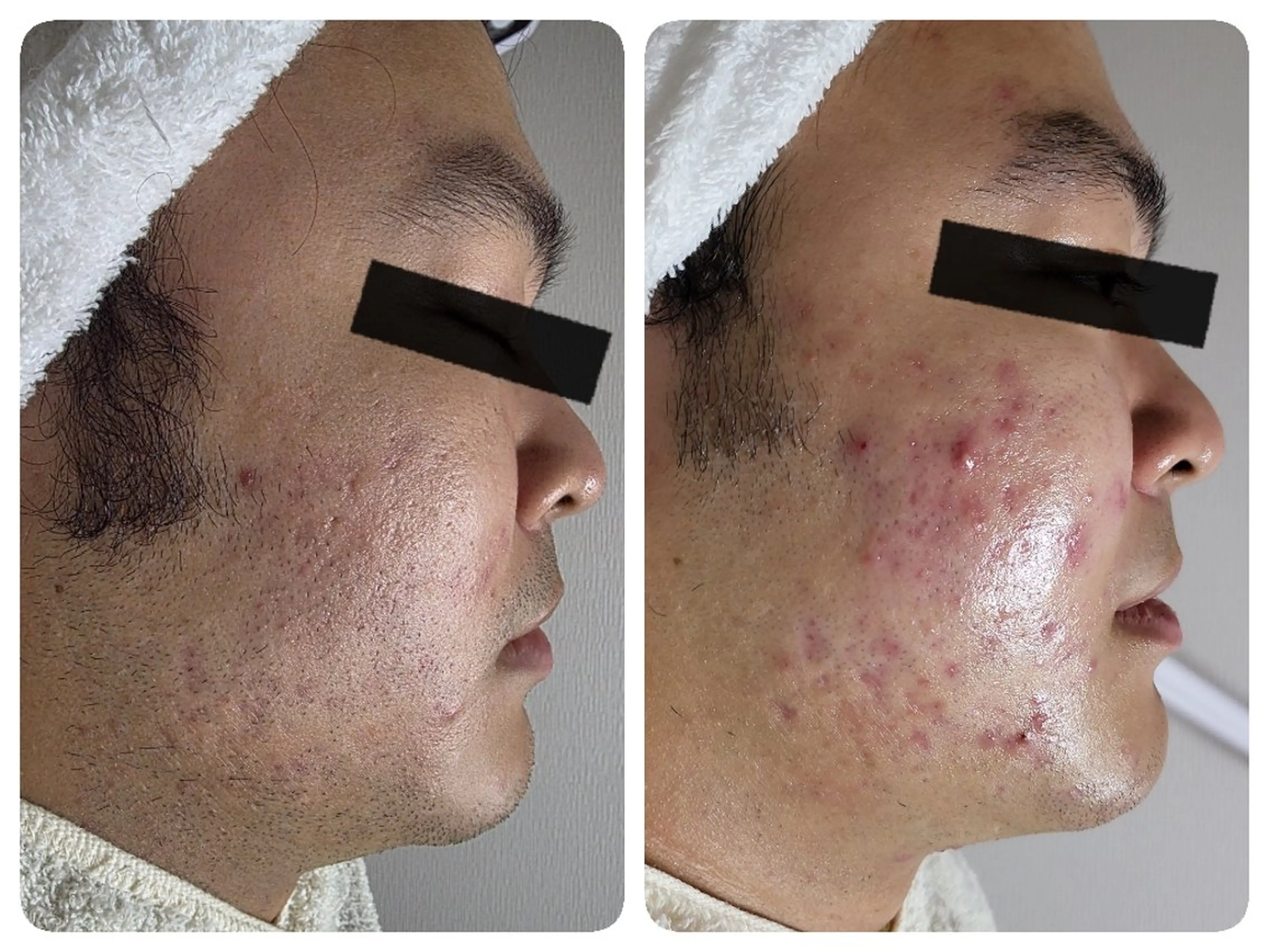 メンズ 〈ニキビケアサロン〉 レゾン京橋店/ 浅川のエステ・リラクイメージ