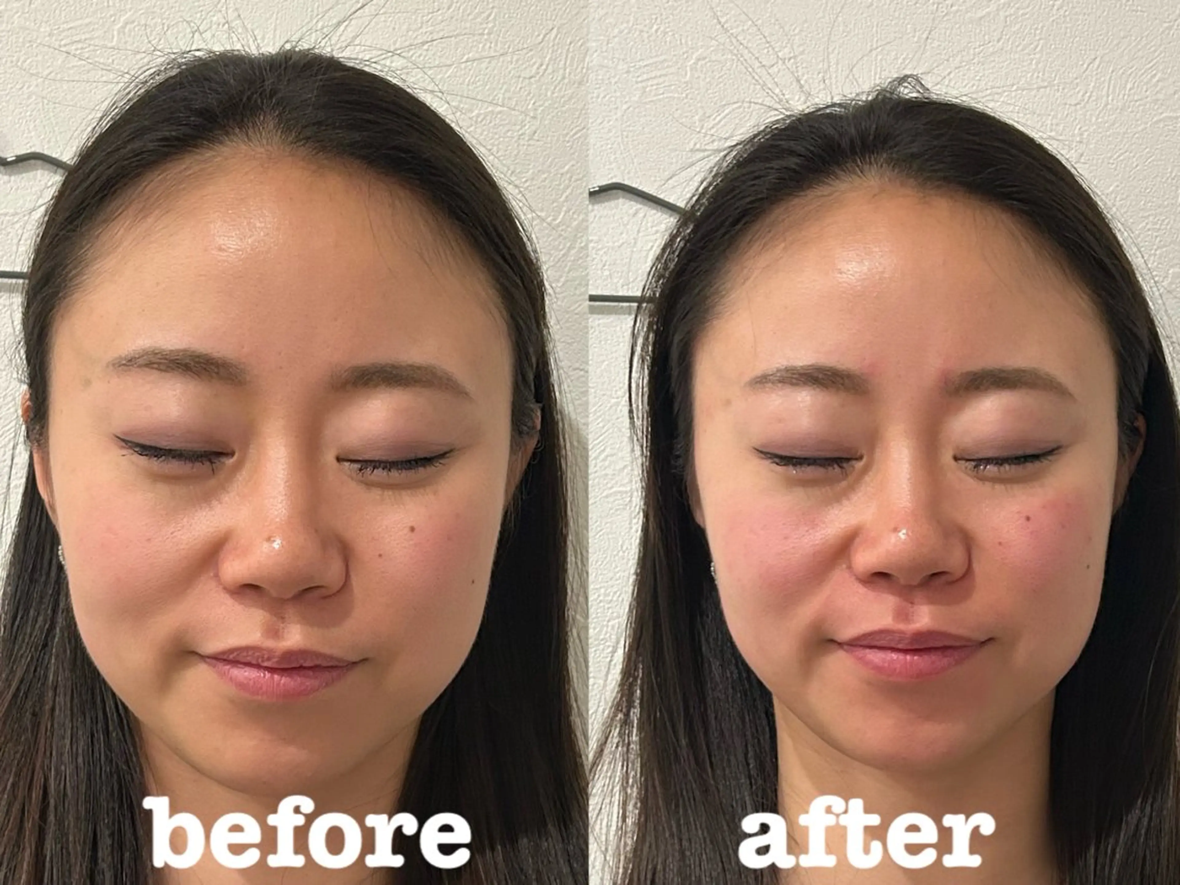 エステ リラク 肌質改善×美容鍼 ゆいのエステ・リラクイメージ