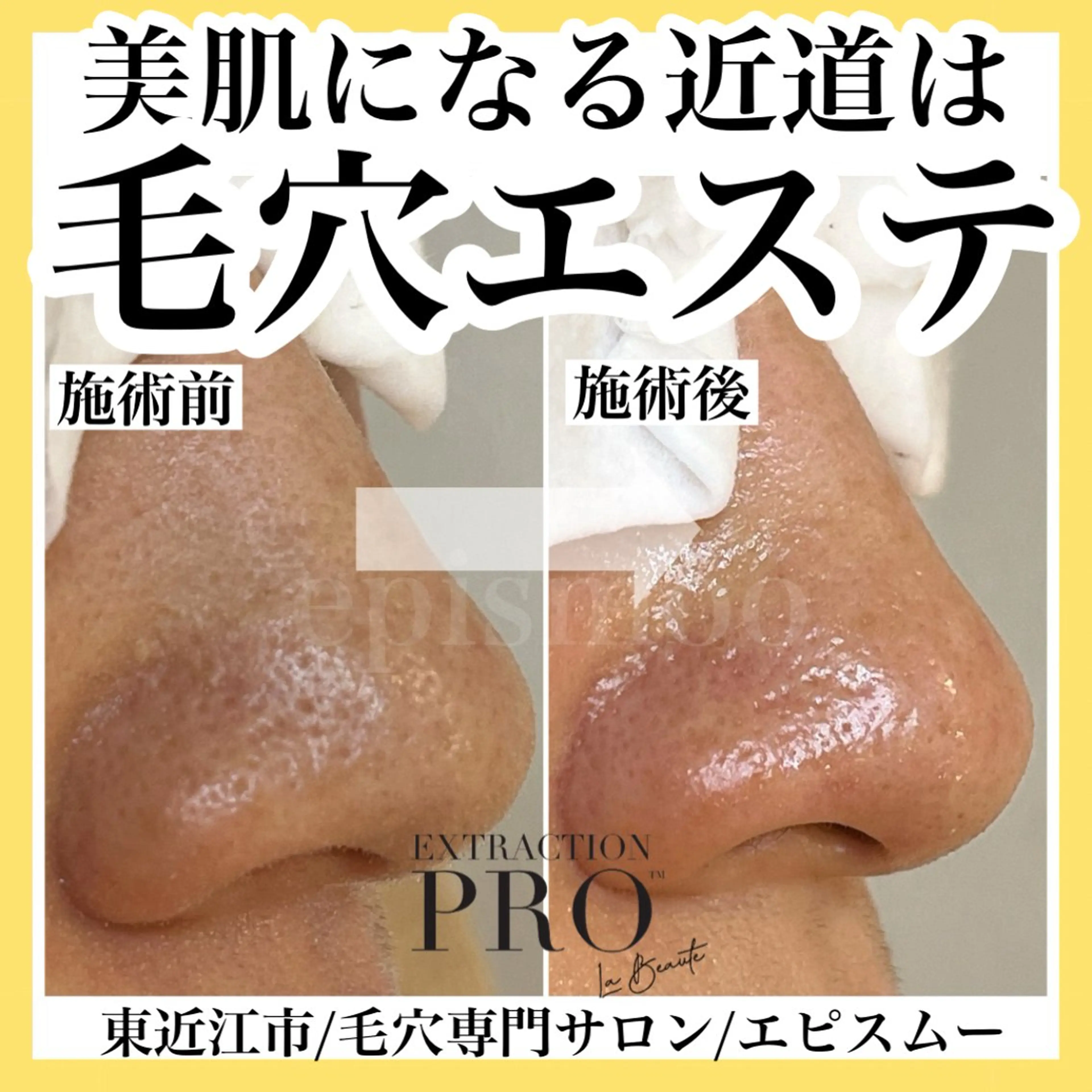 メンズ epismoo 脱毛/HBL/毛穴の眉毛・アイブロウイメージ