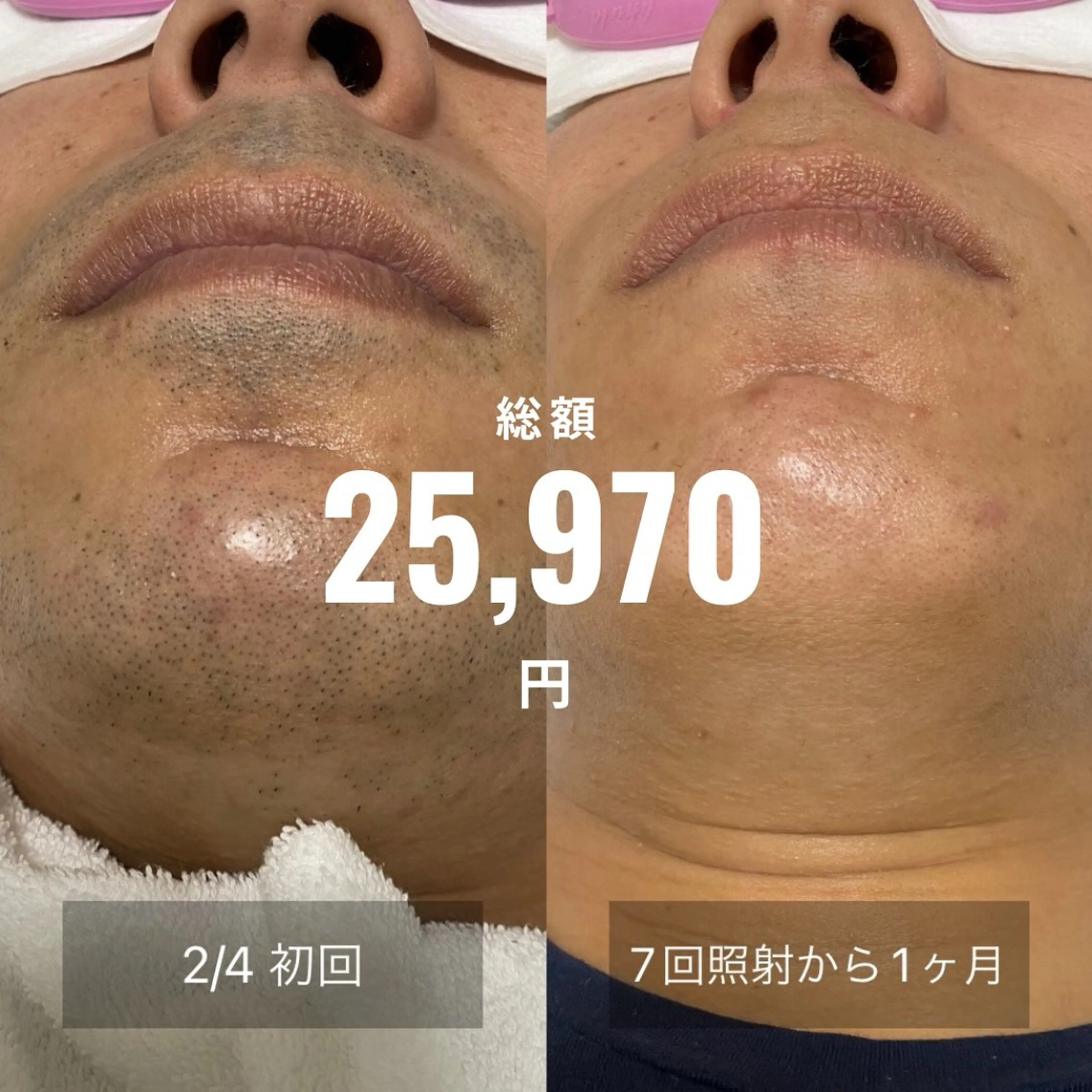 メンズ 港区都度払い脱毛 miranjuのエステ・リラクイメージ