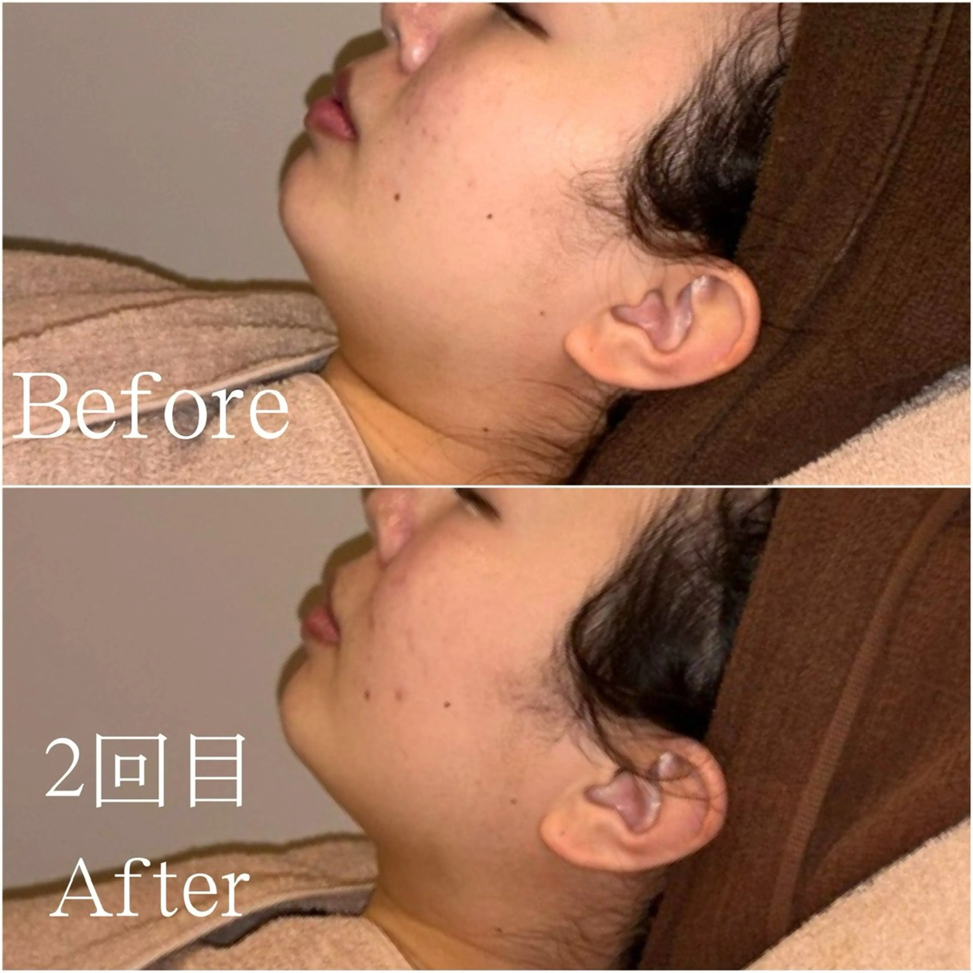 人気No.1!【小顔脂肪ぶんかいケア☆】気になる二重あごやフェイスラインをスッキリ改善✨の写真