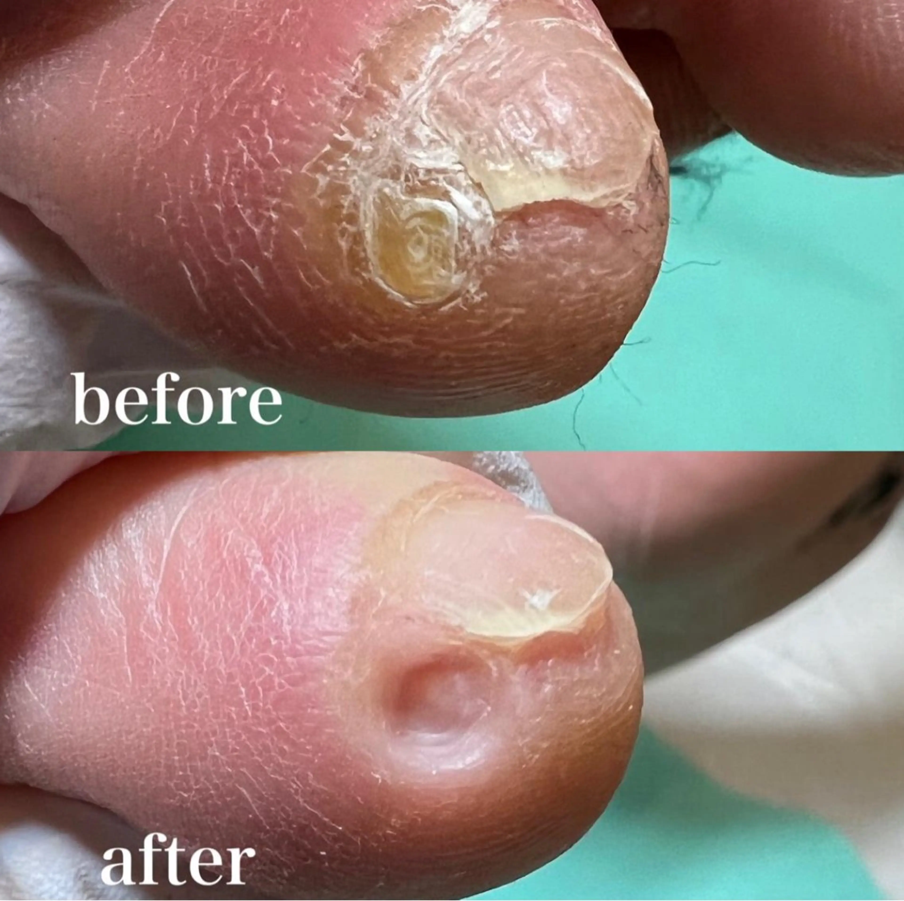 【副爪ケア】小指の爪横にある爪みたいなモノ💡キレイにします💁‍♀️の写真