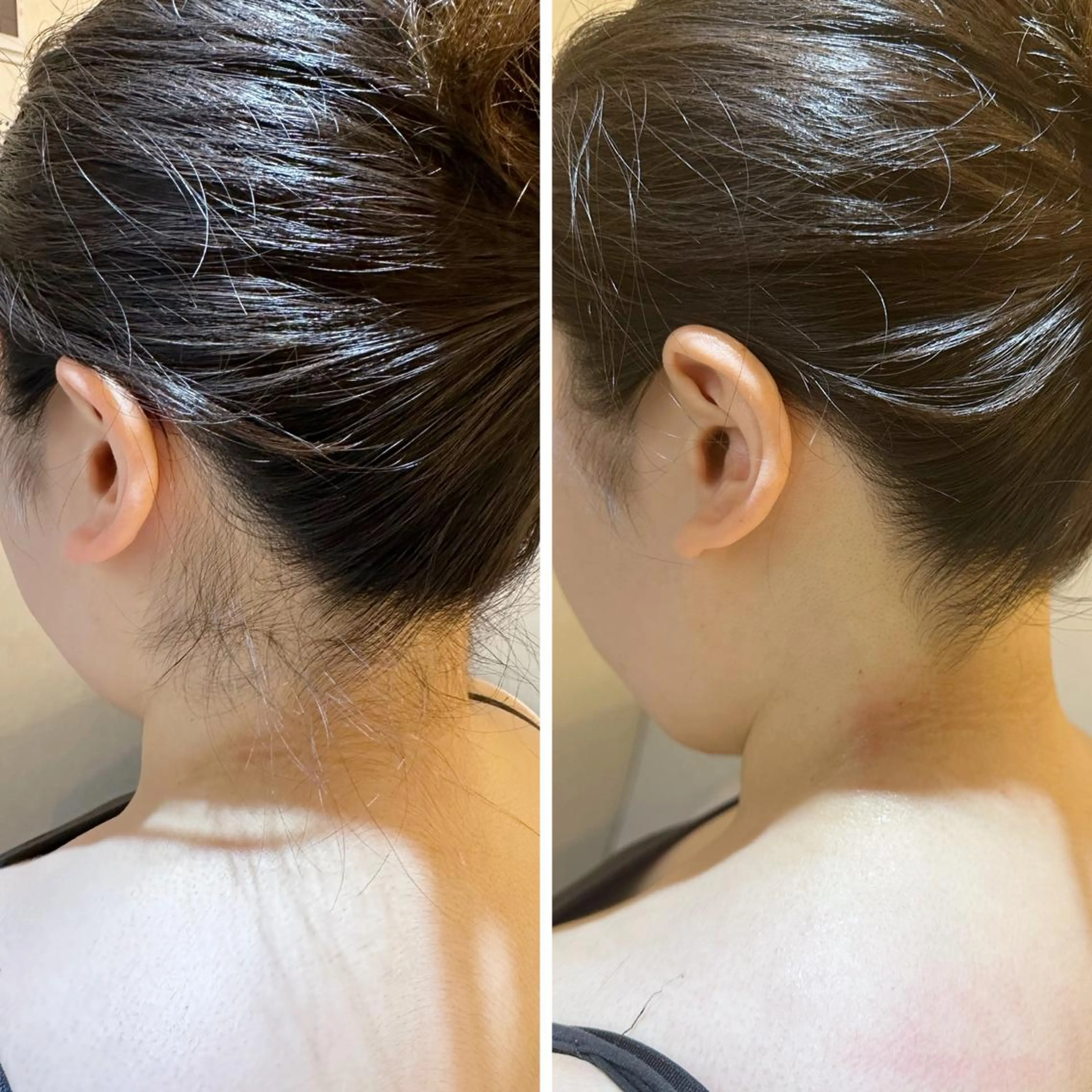 脱毛 うなじ脱毛/美肌脱毛 LABELのエステ・リラクイメージ